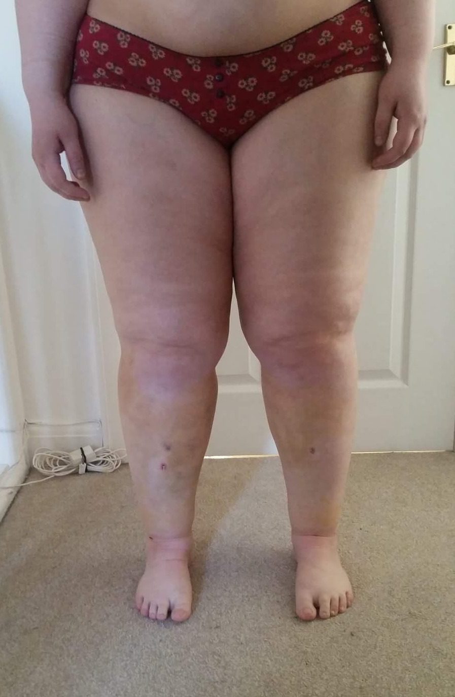 Lower limb lipoedema liposuction patient 1 day 7 1