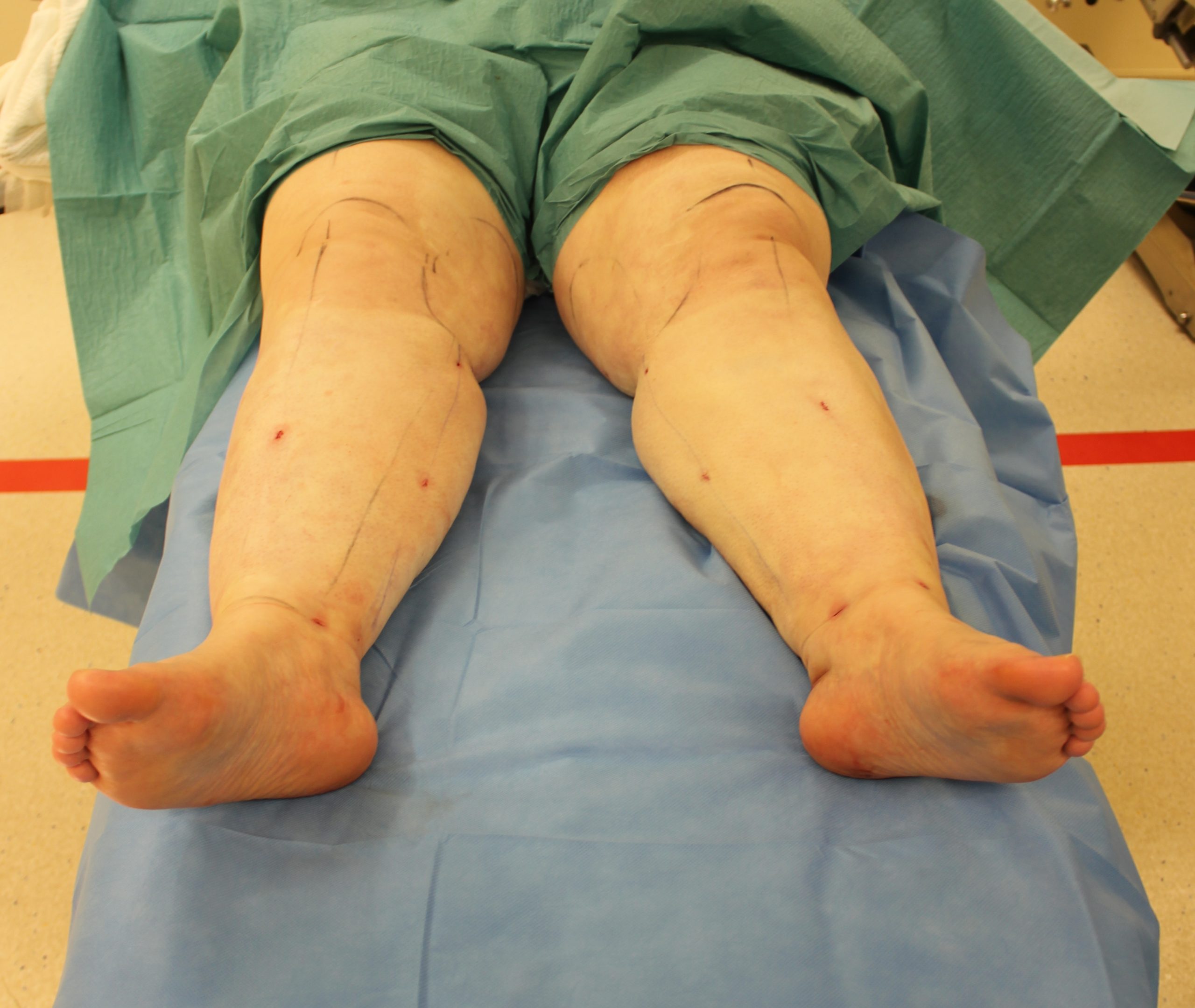 Lower limb lipoedema liposuction patient 1 immediate postop scaled