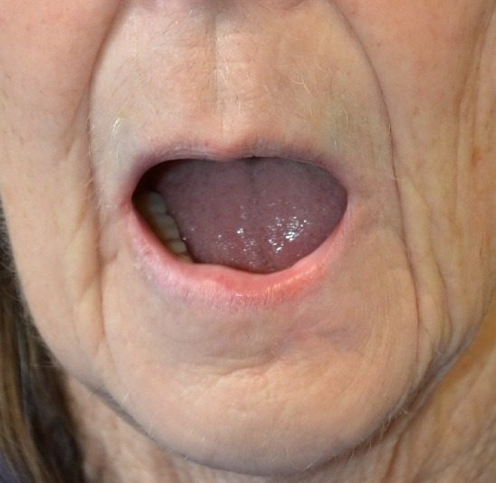 Lower lip skin cancer reconstruction post op with mouth open