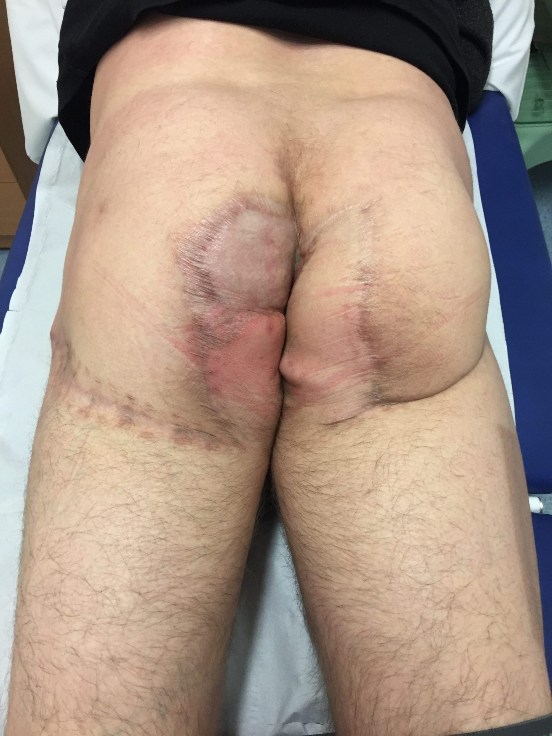 Perineum hidradenitis supprativa after flap reconstruction e 1478613123839 scaled