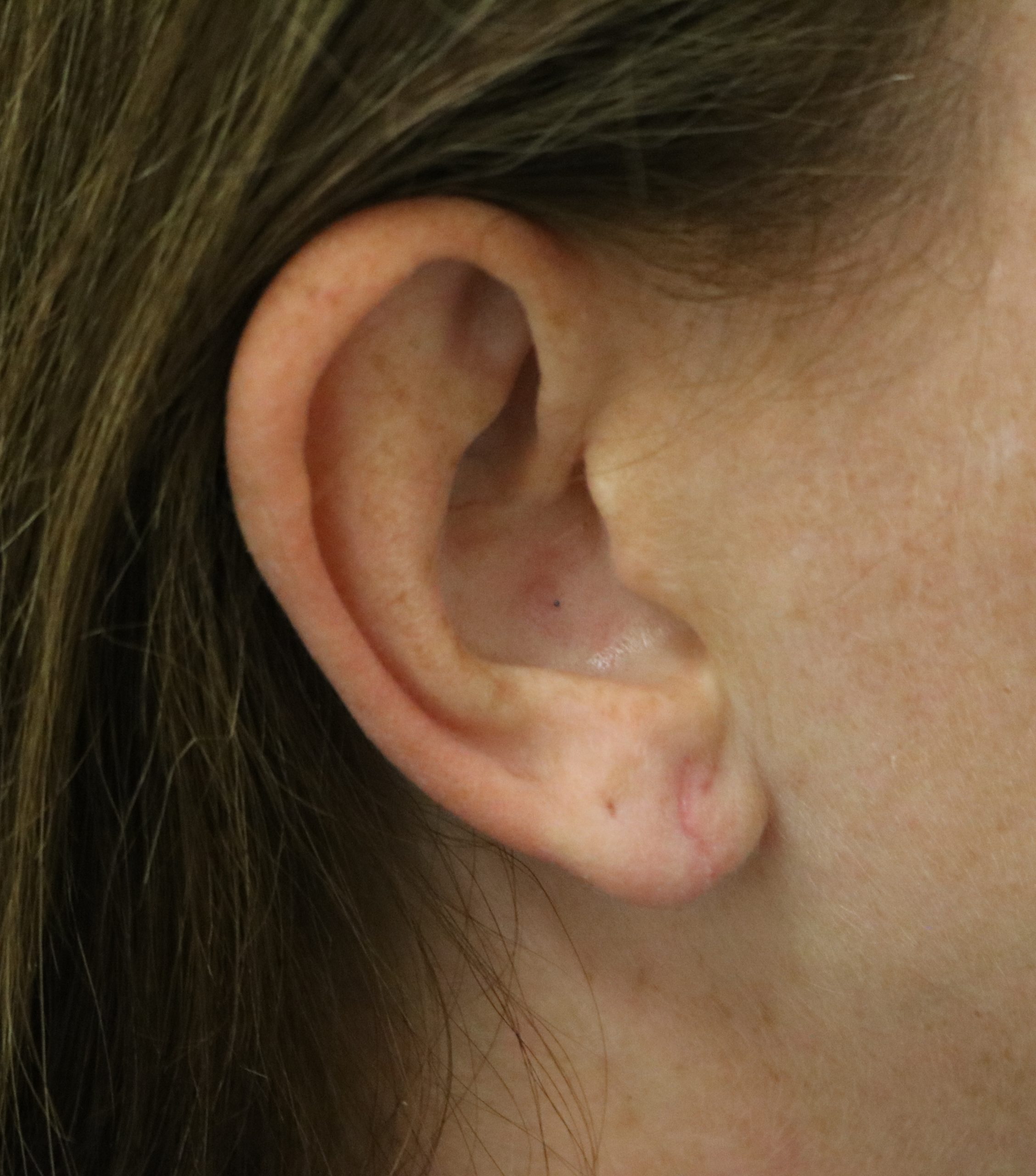 Split earlobe repair after scaled