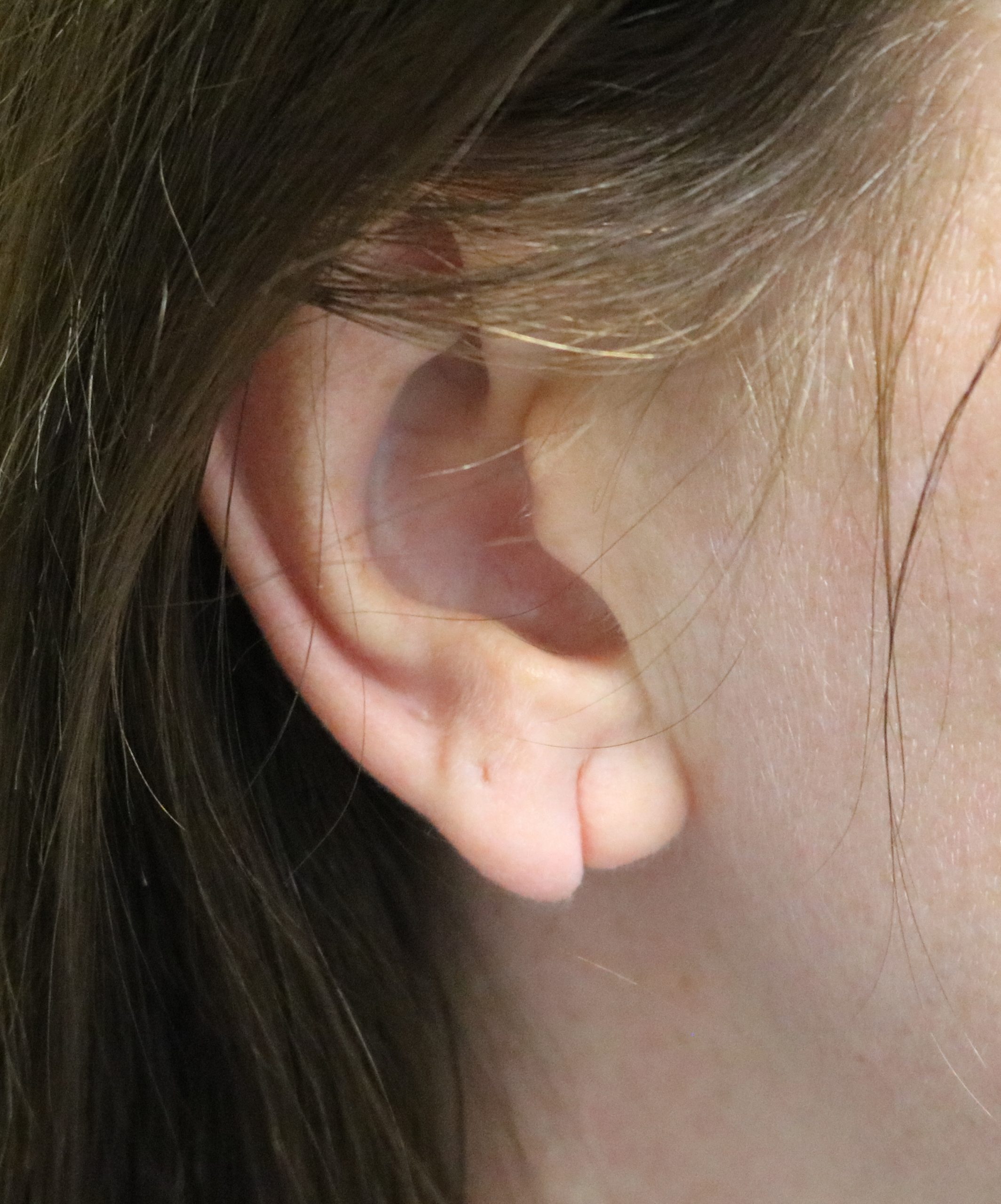 Split earlobe repair before scaled
