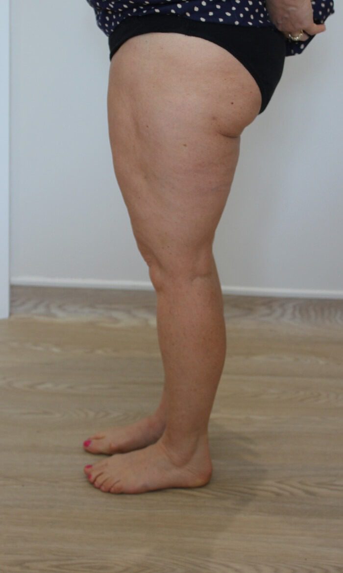 Thigh liposuction after left lateral 1