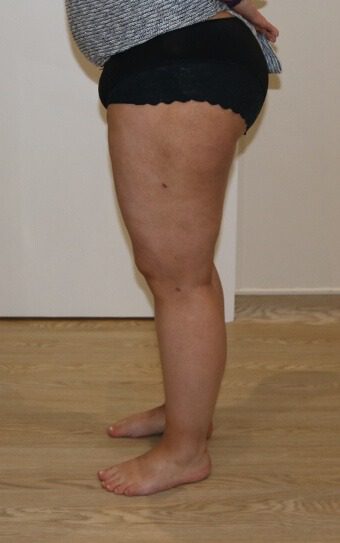 Thigh liposuction after left lateral