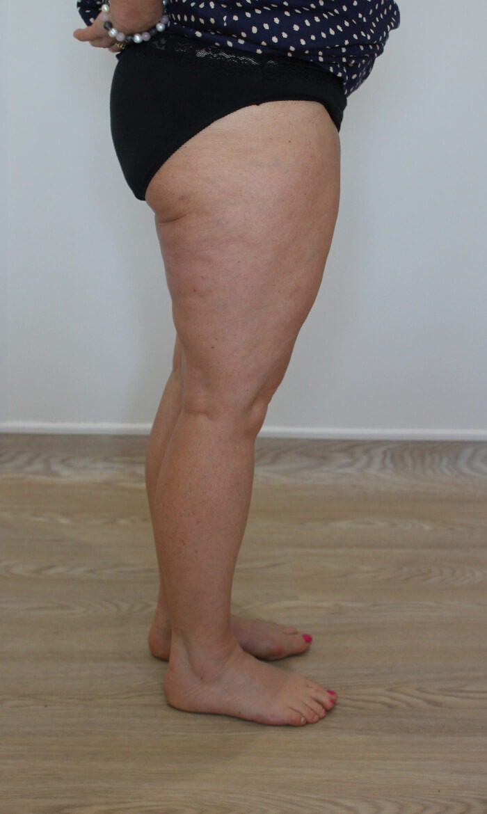 Thigh liposuction after right lateral 1