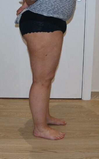 Thigh liposuction after right lateral