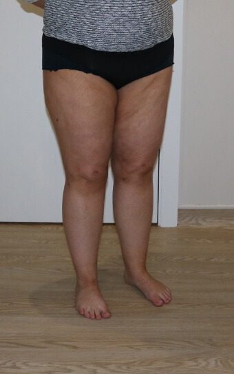 Thigh liposuction after right oblique