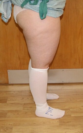 Thigh liposuction before right lateral