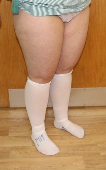 Thigh liposuction before right oblique
