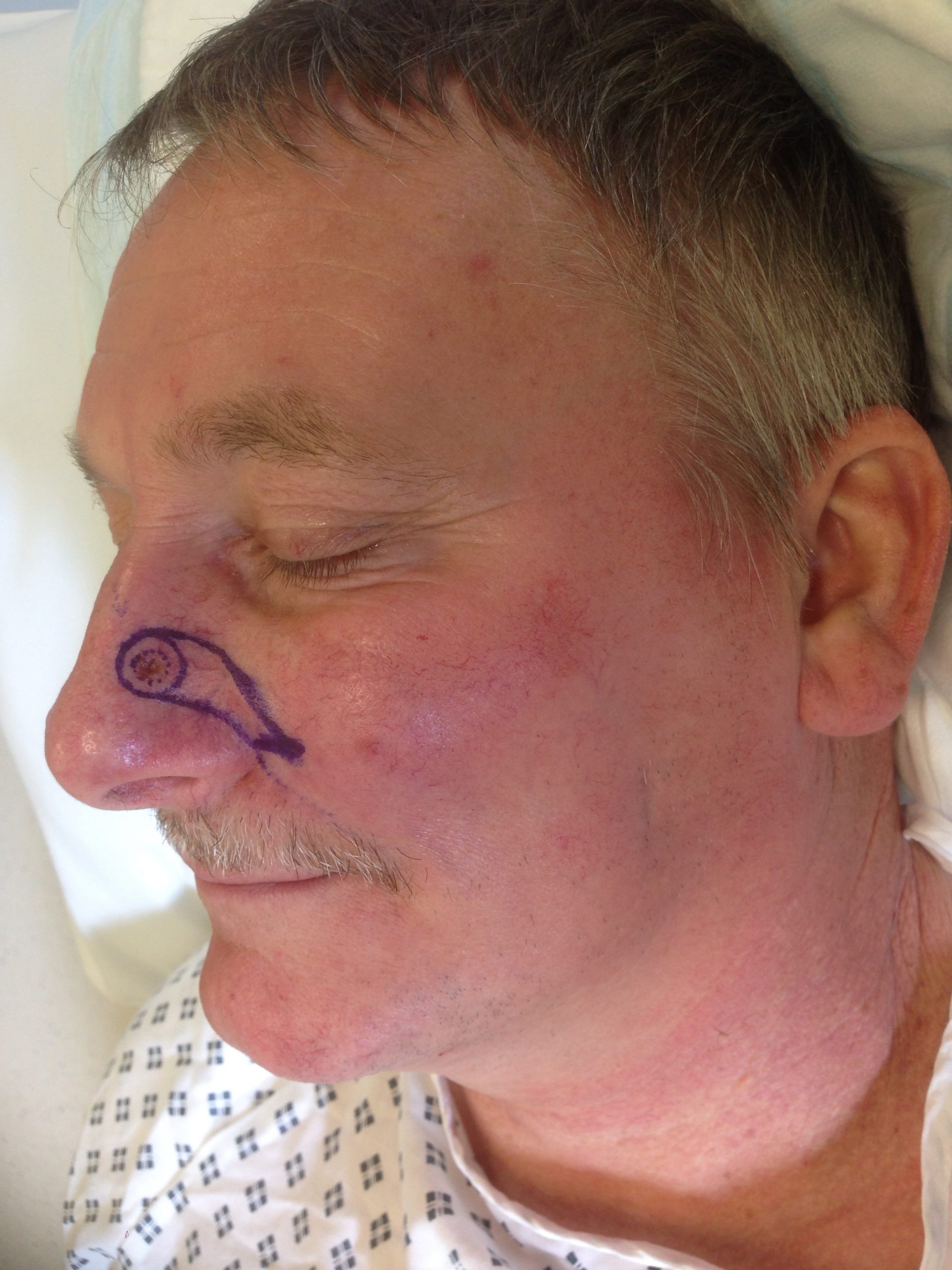 V Y advancement flap patient 1 before scaled