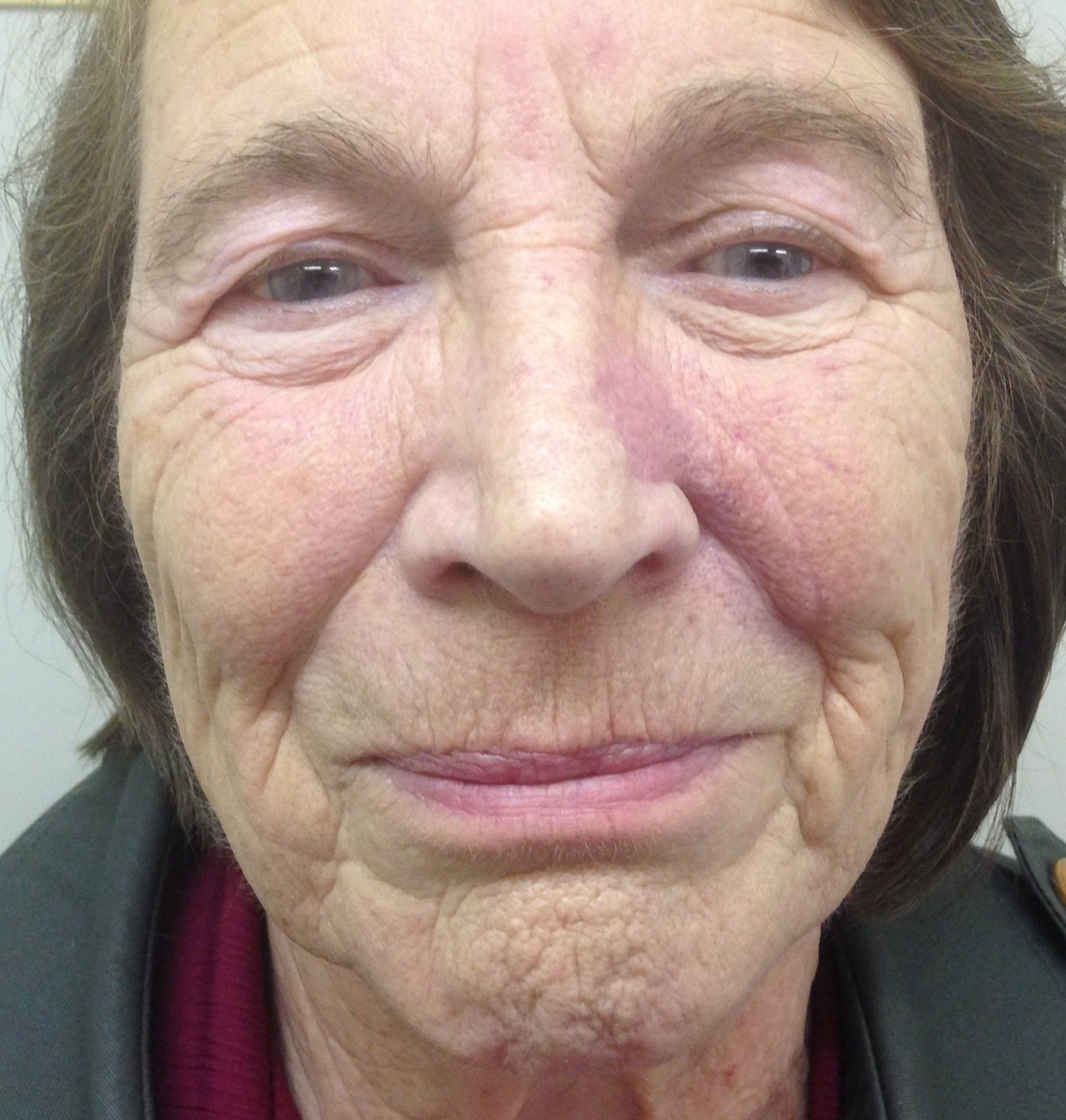 V Y advancement flap patient 2 after AP view