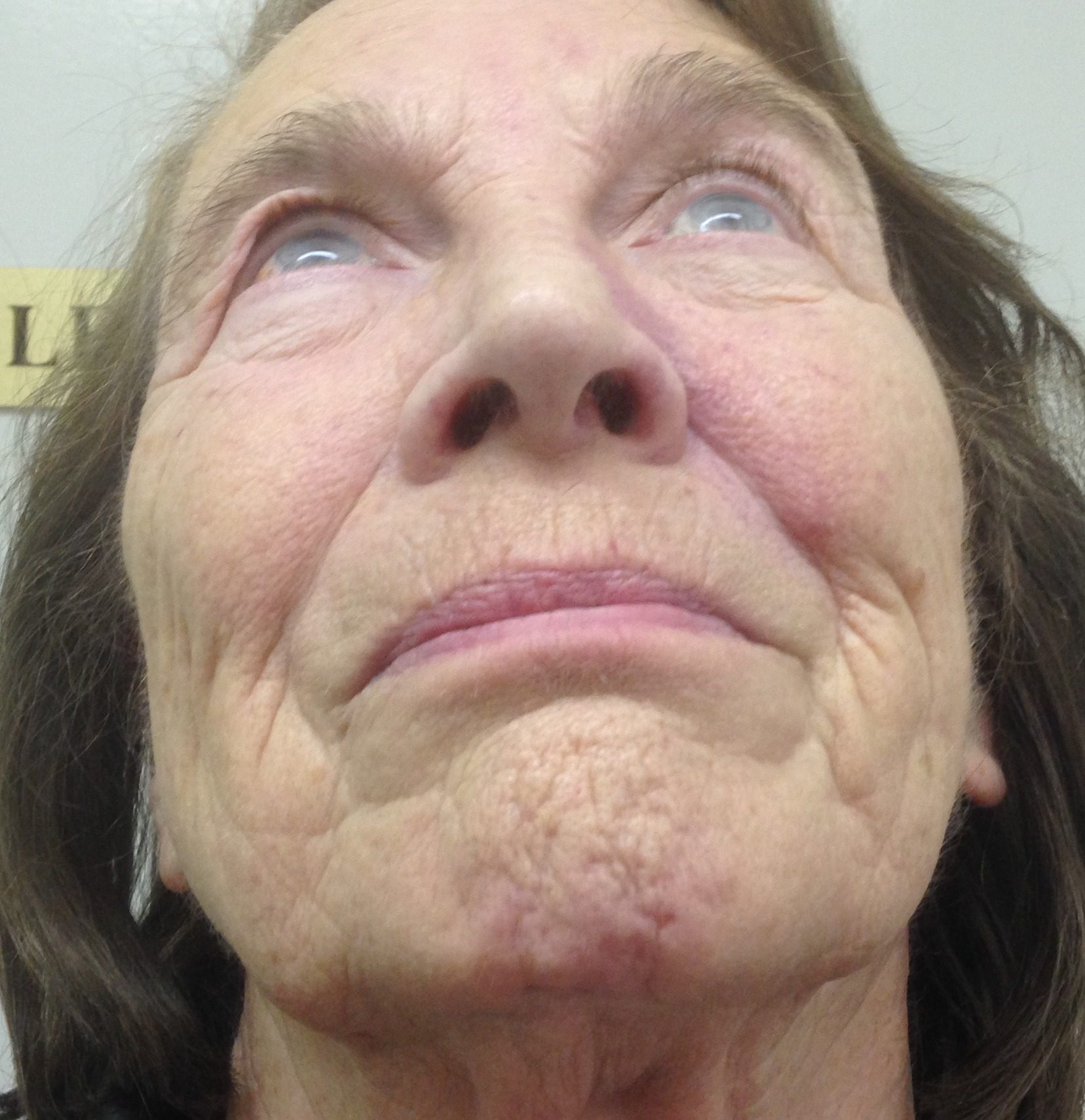 V Y advancement flap patient 2 after wormseye view