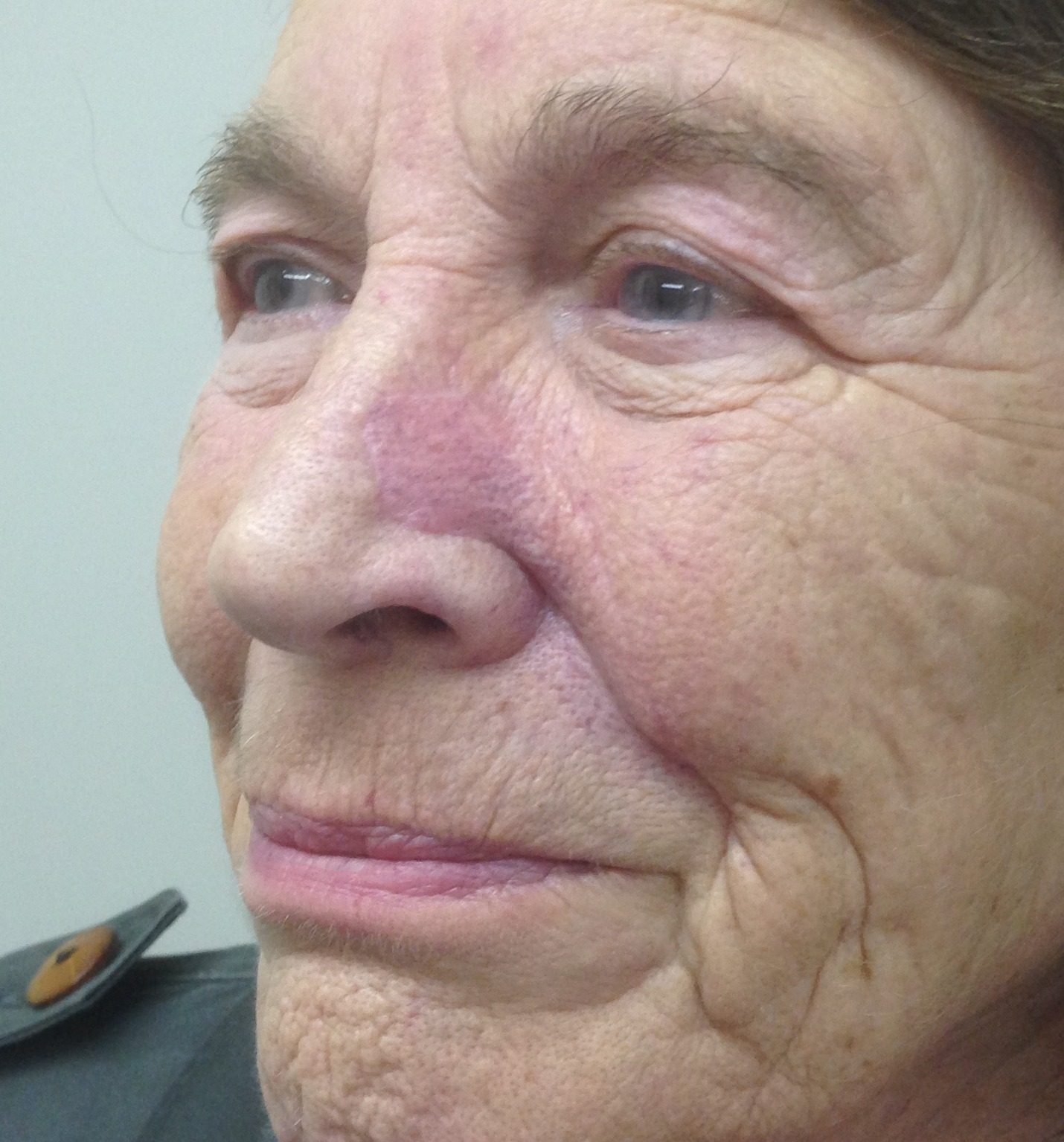 V Y advancement flap patient 2 after
