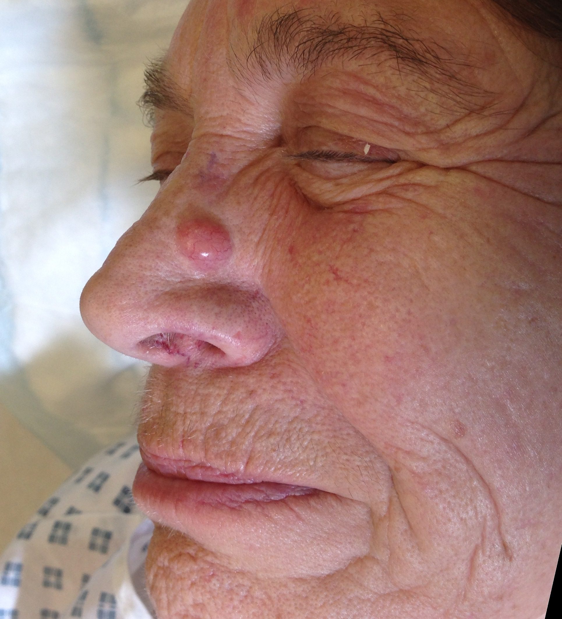 V Y advancement flap patient 2 before