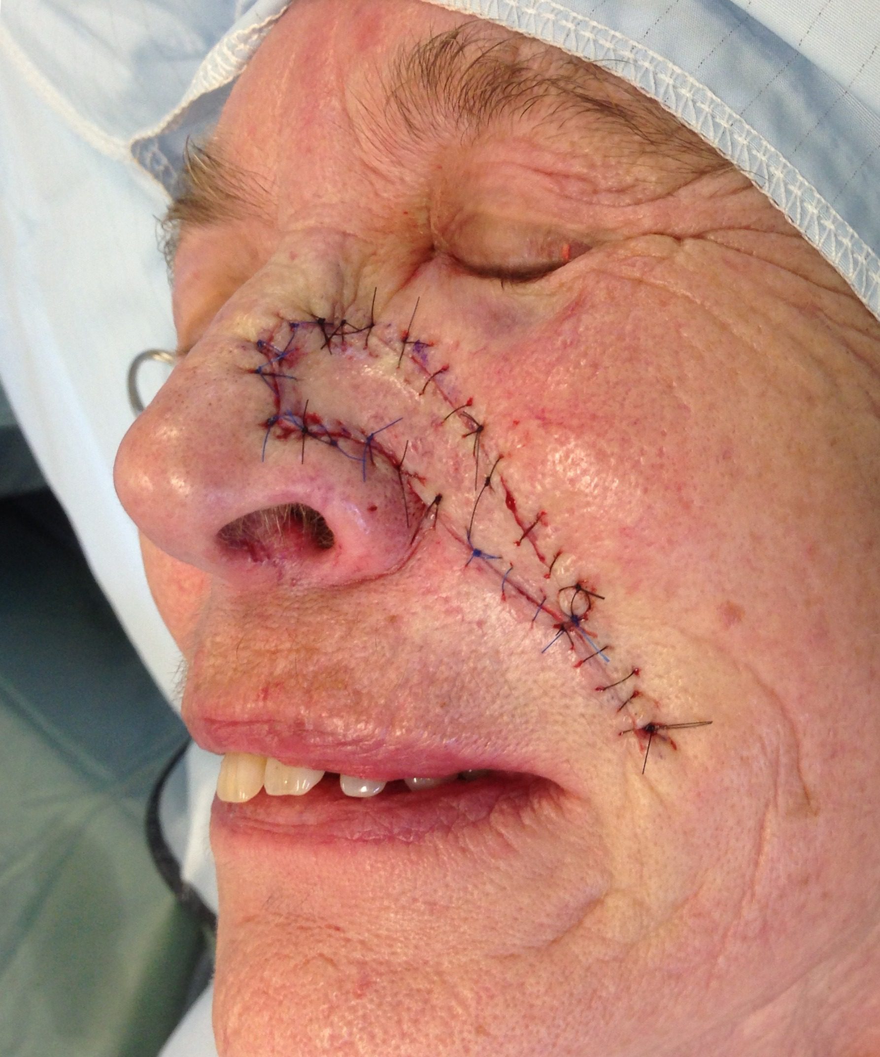 V Y advancement flap patient 2 flap inset