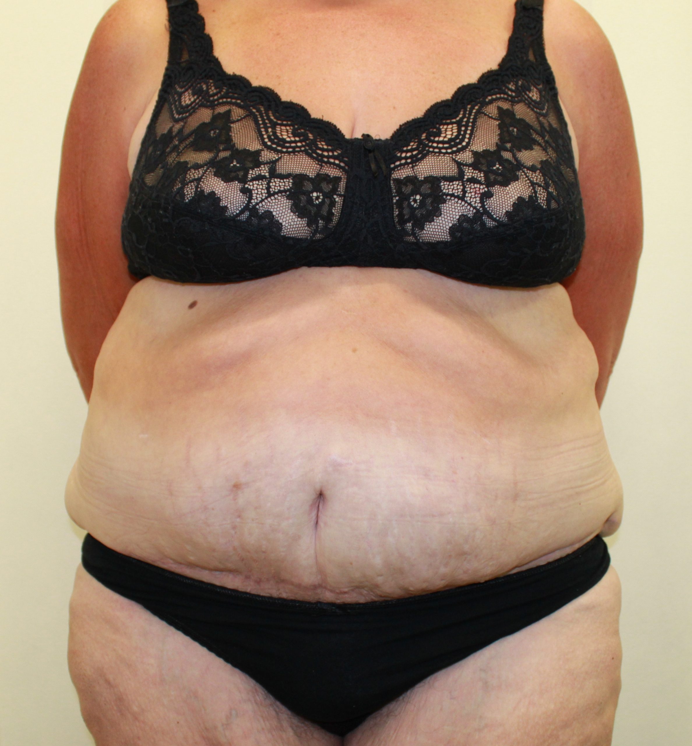 abdominoplasty patient 1 after AP view scaled