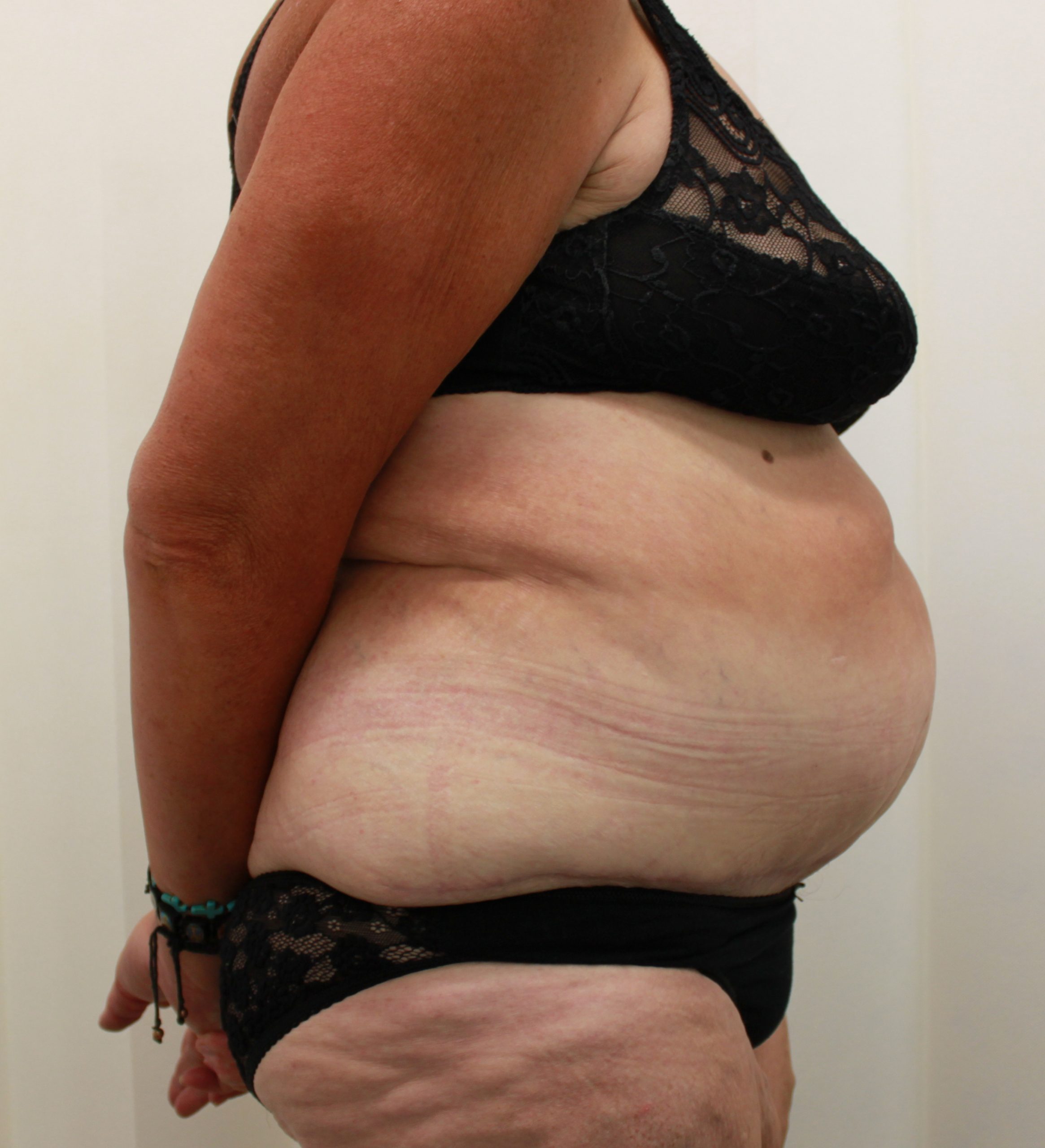 abdominoplasty patient 1 after lateral scaled