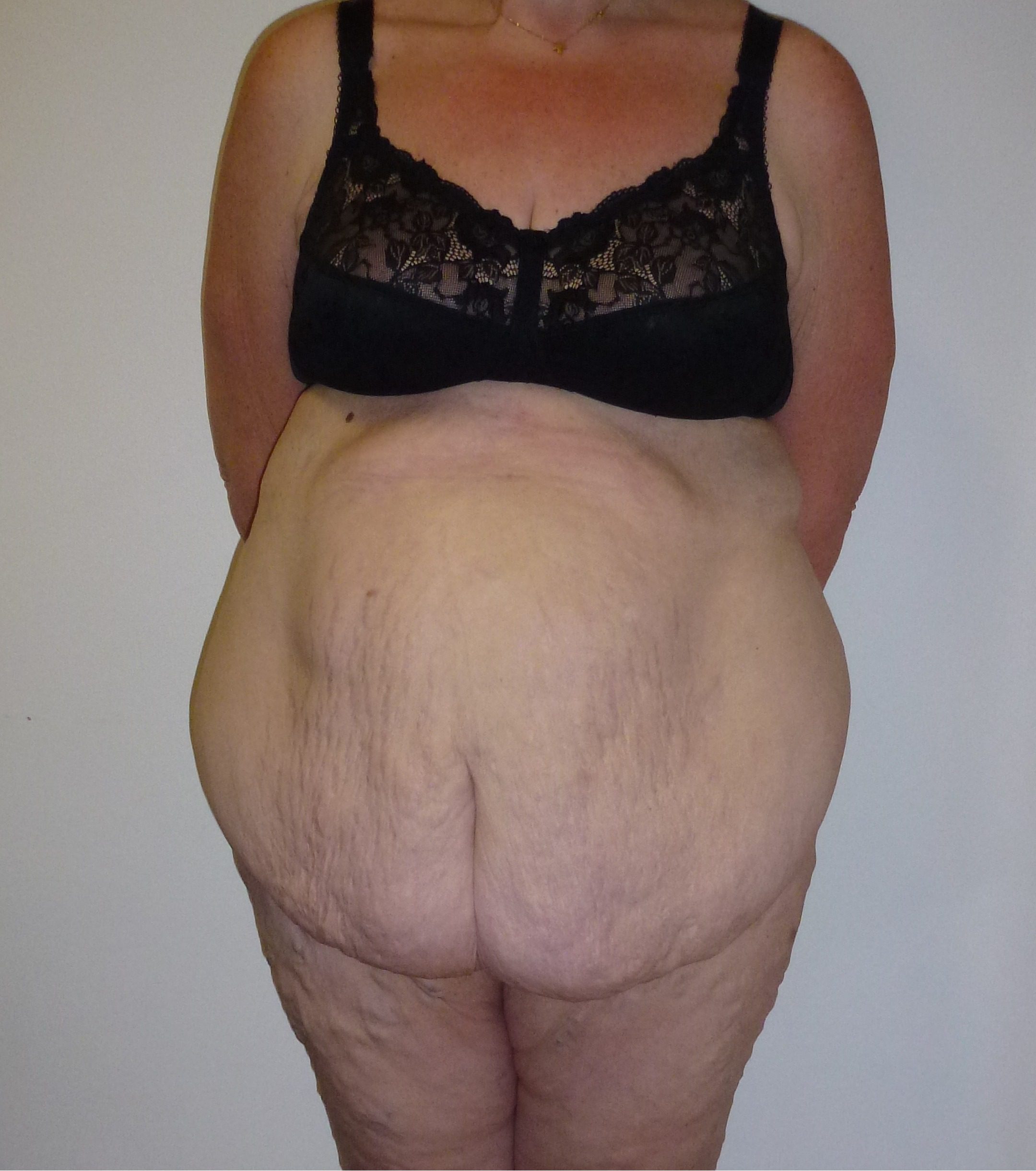 abdominoplasty patient 1 before AP view