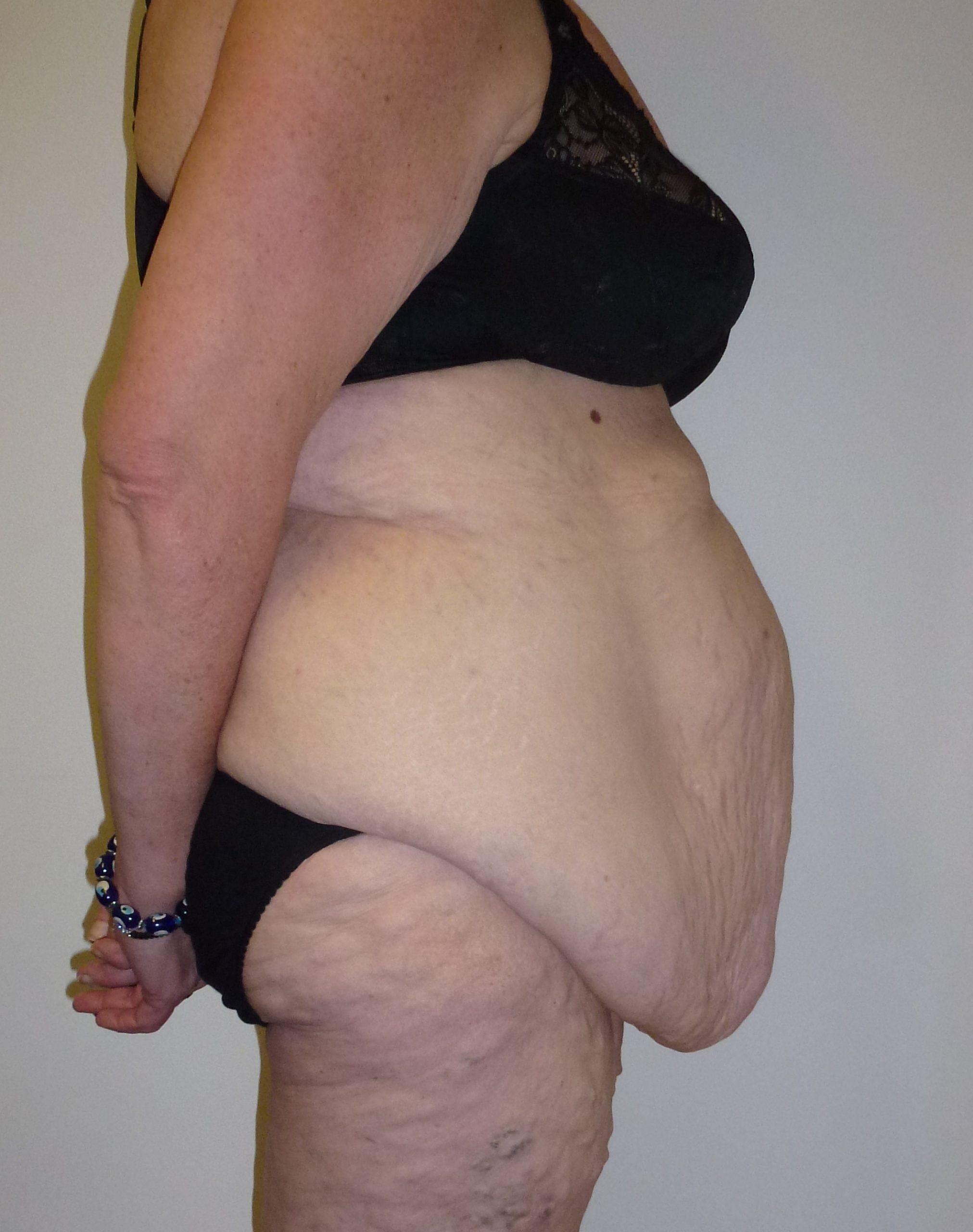 abdominoplasty patient 1 before lateral scaled