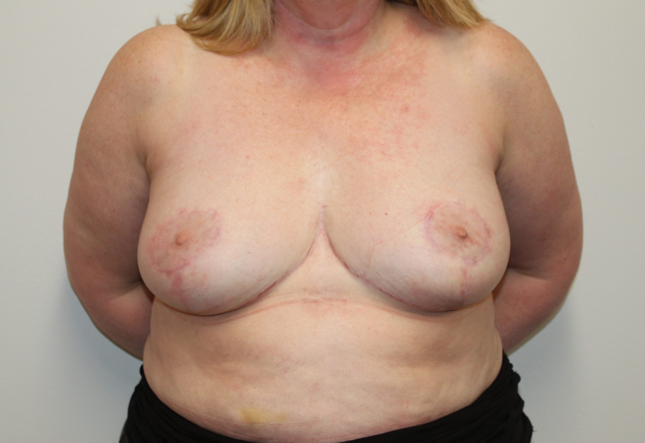 breast reduction patient 5 after AP view scaled