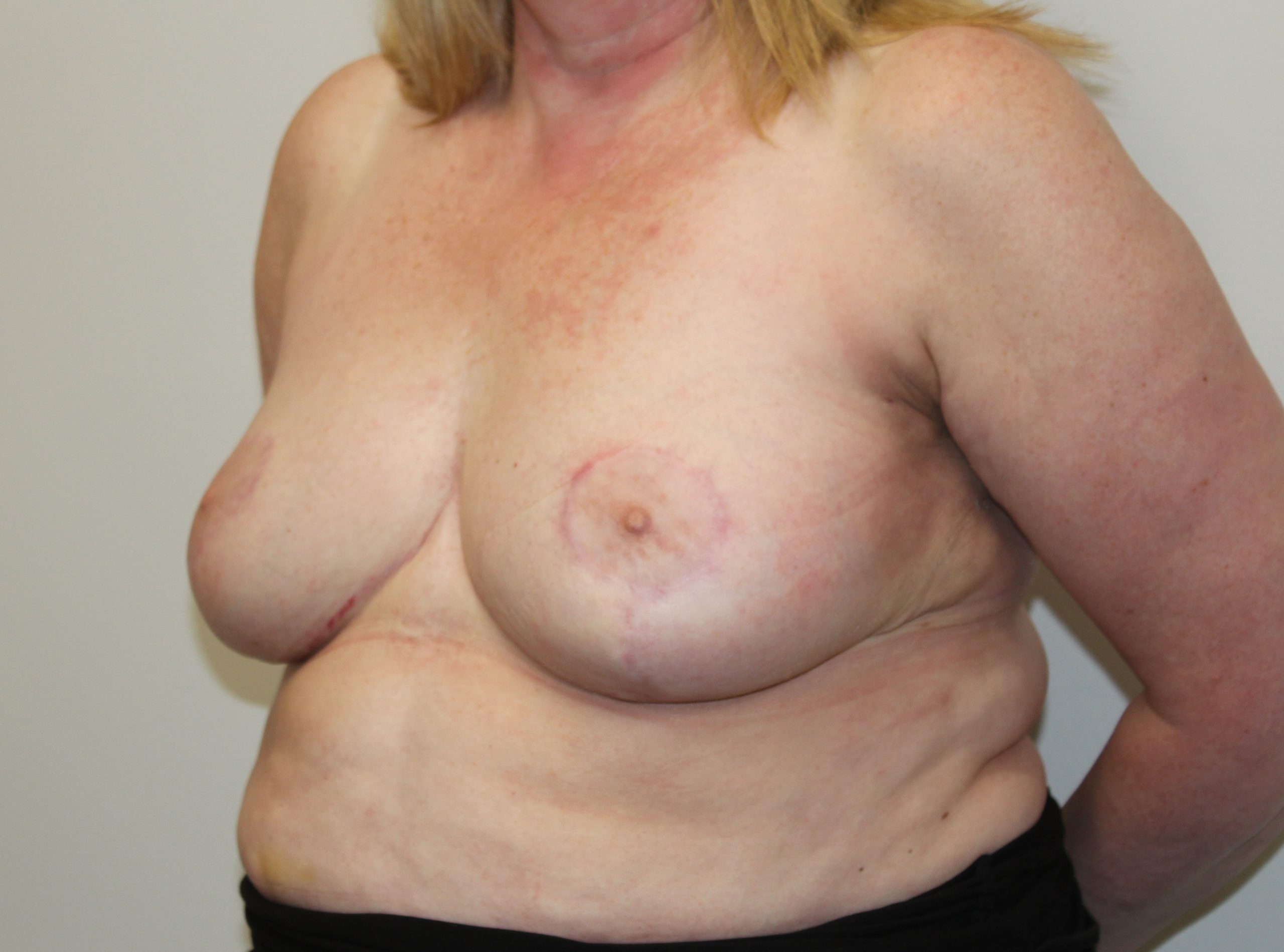 breast reduction patient 5 after left oblique scaled