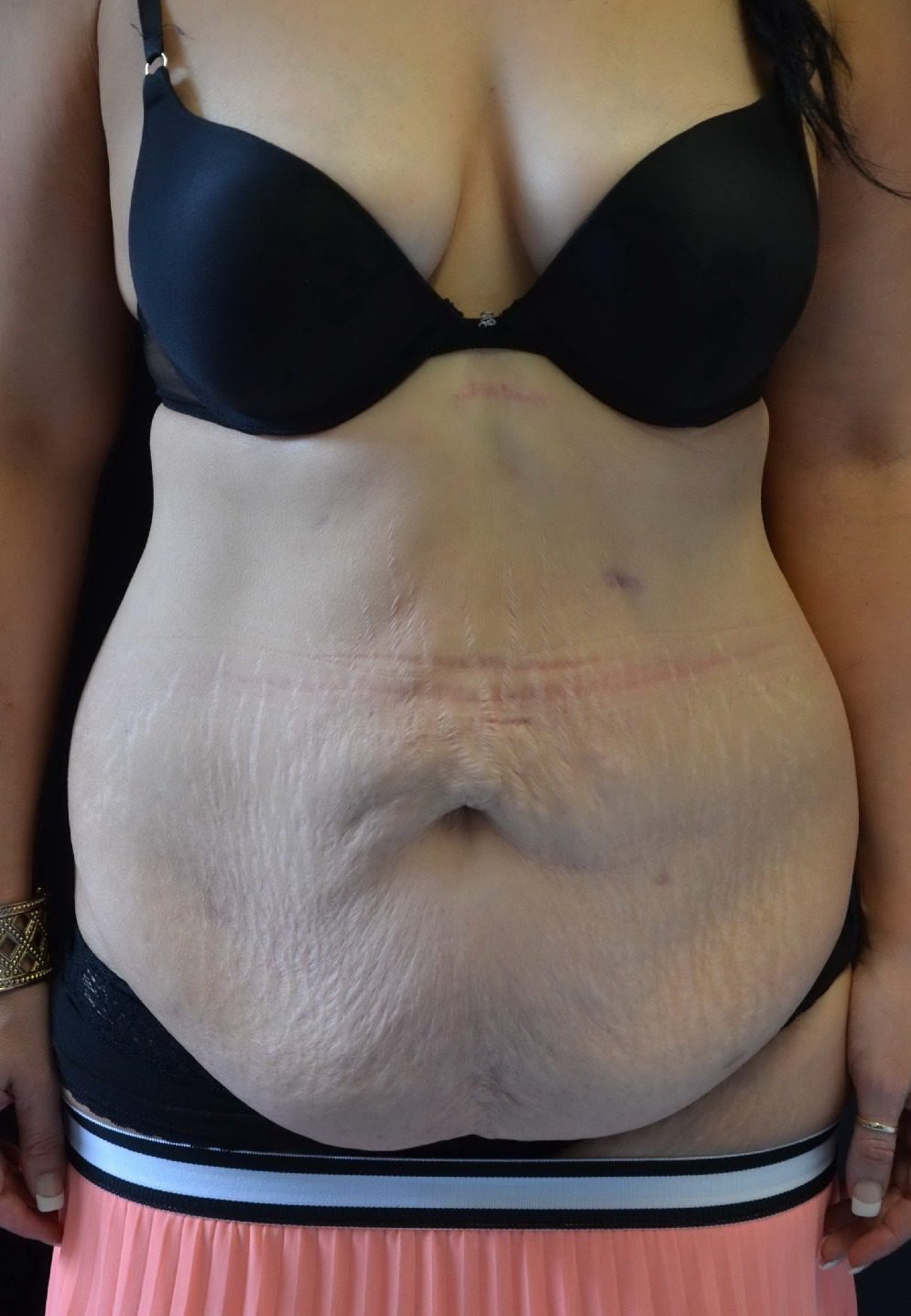 fleur de lis abdominoplasty before AP view