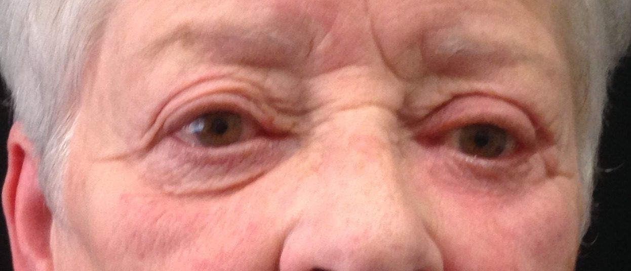 hemi Tripier flap reconstruction of lower eyelid patient 1 after