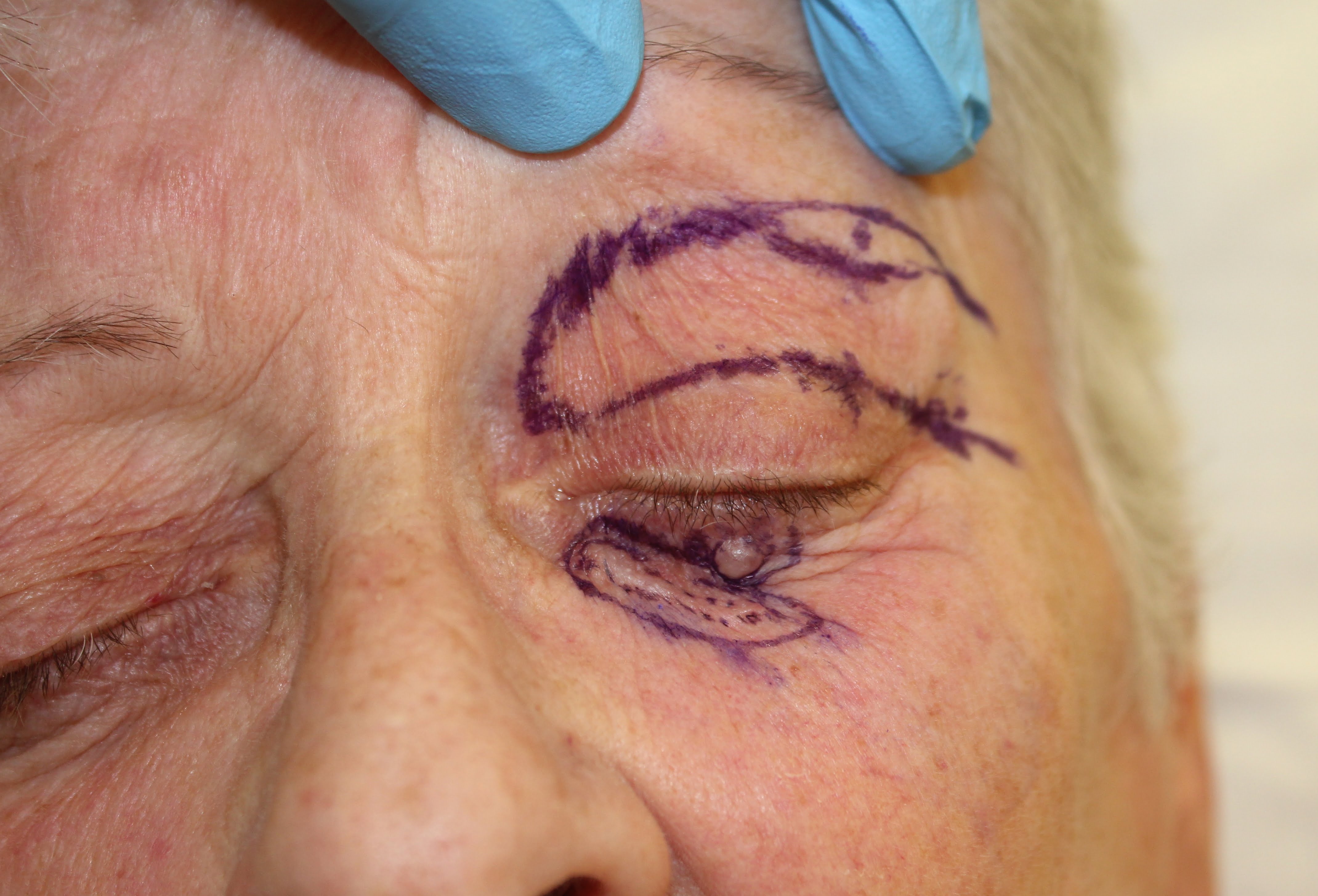 hemi Tripier flap reconstruction of lower eyelid patient 1 before
