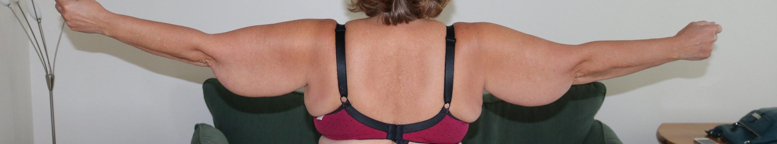 lipoedema arms liposuction type IV patient 1 before posterior view scaled