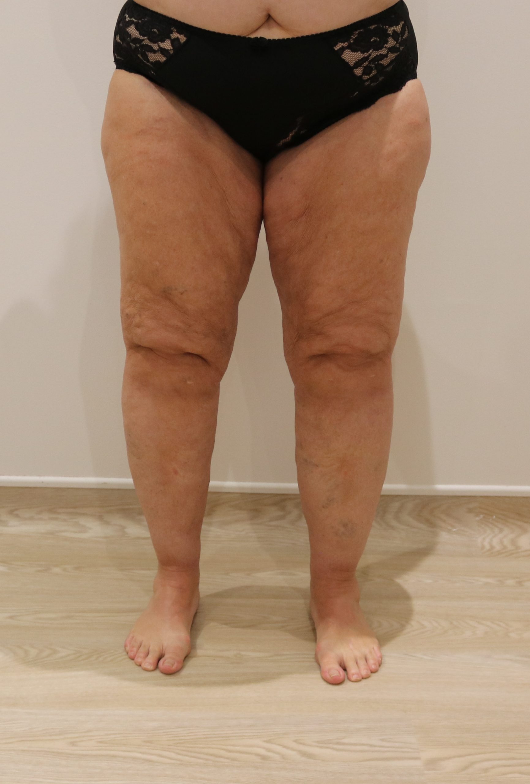 lipoedema lower limbs liposuction type IV after AP view scaled