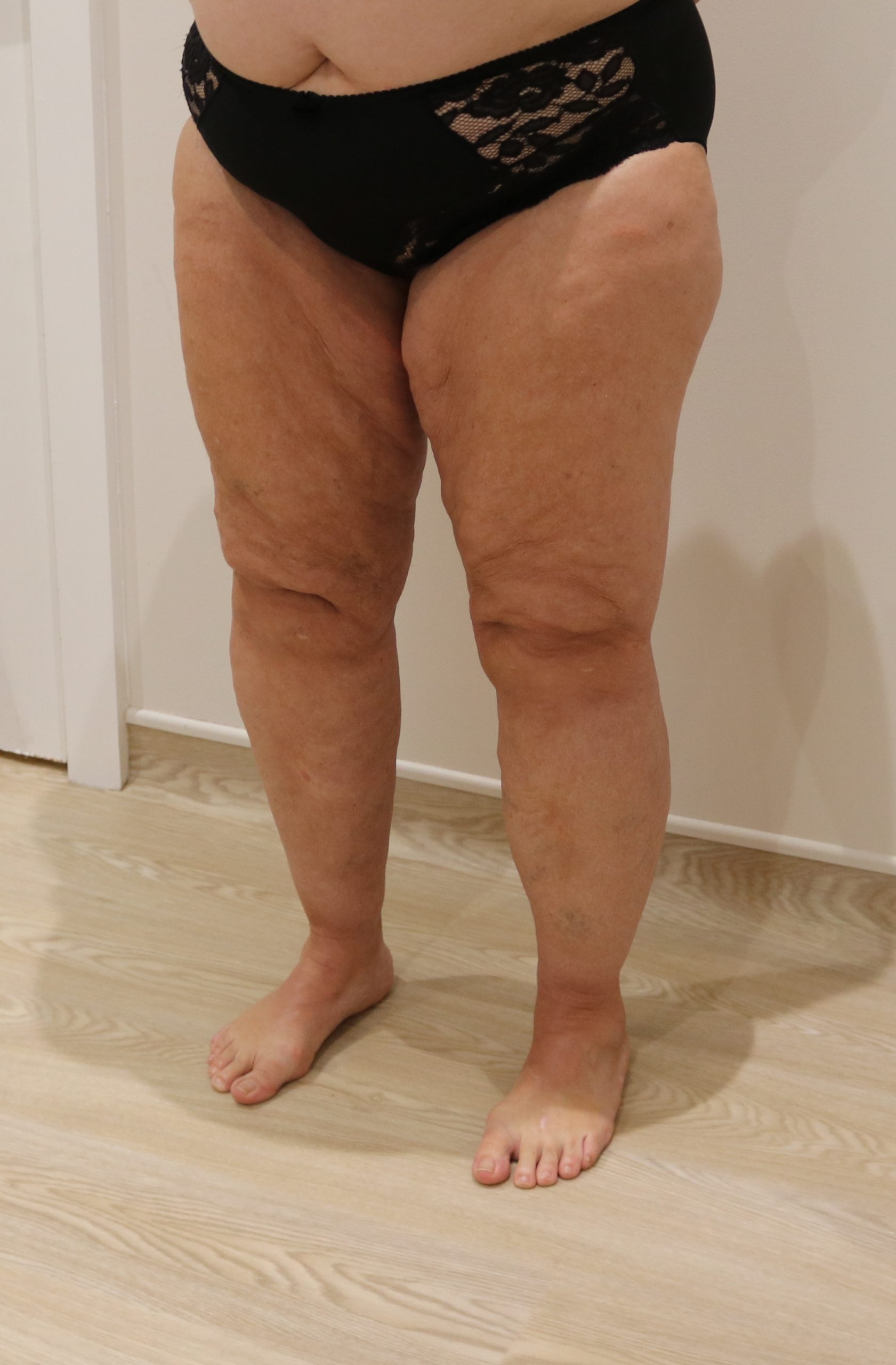 lipoedema lower limbs liposuction type IV after left oblique scaled