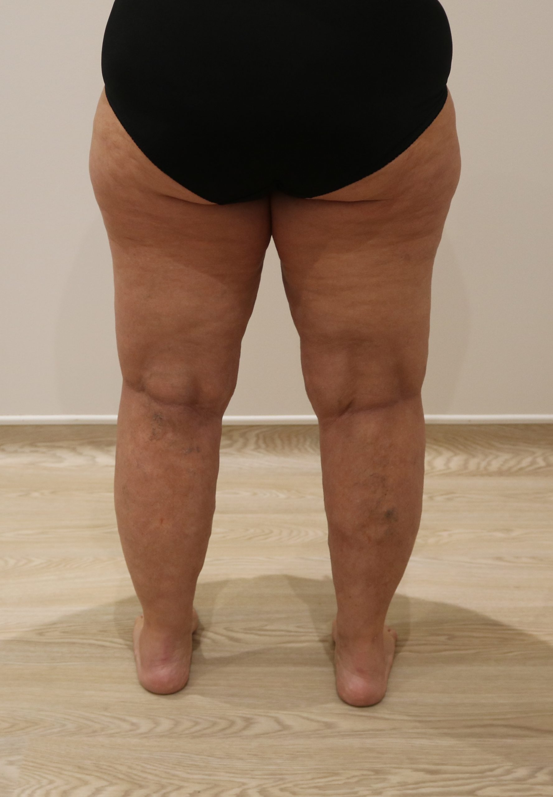 lipoedema lower limbs liposuction type IV after posterior view scaled
