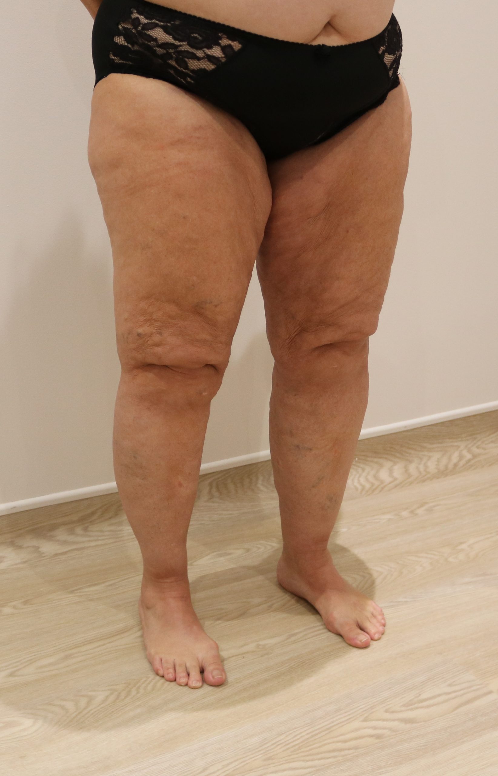 lipoedema lower limbs liposuction type IV after right oblique scaled