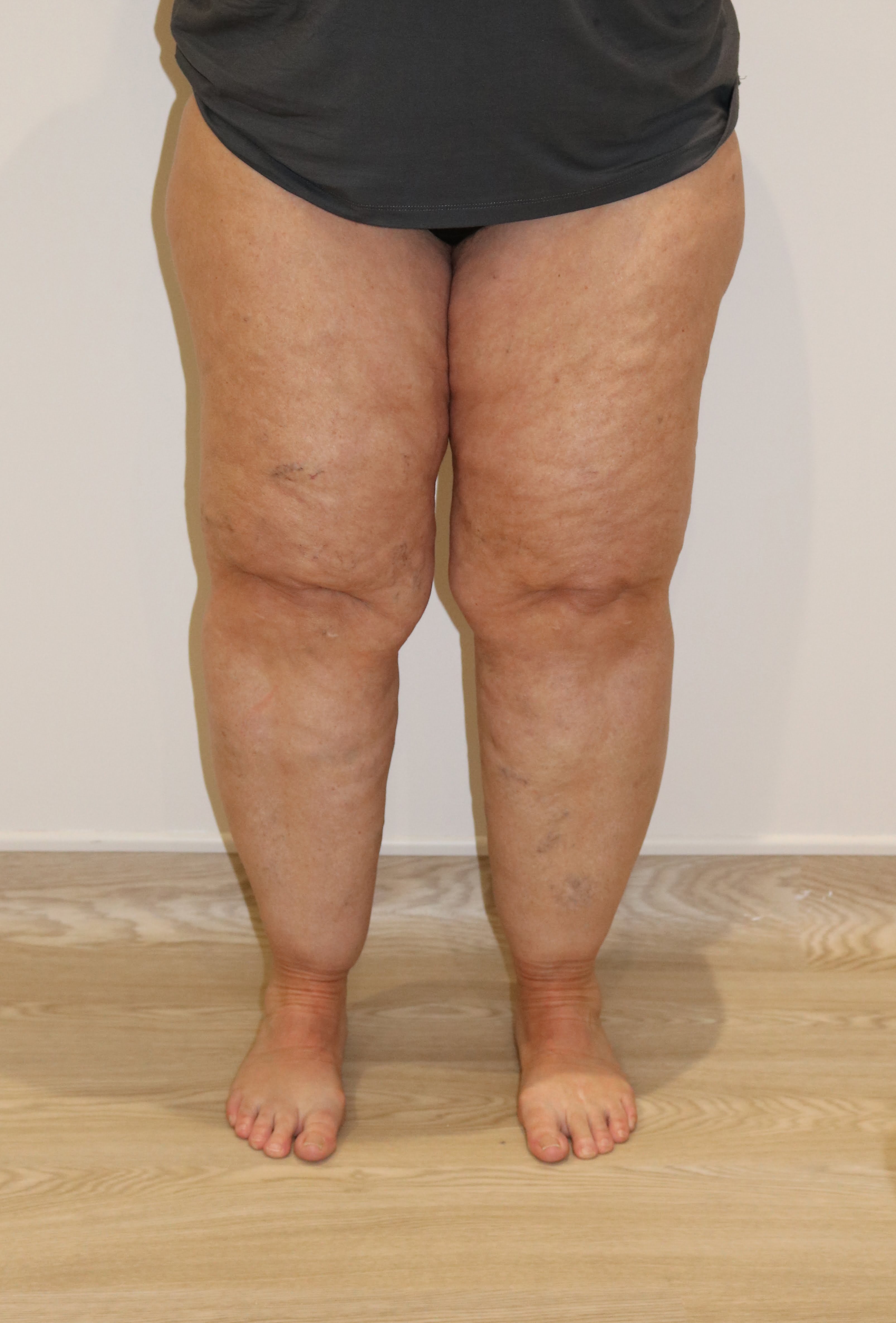 lipoedema lower limbs liposuction type IV before AP view