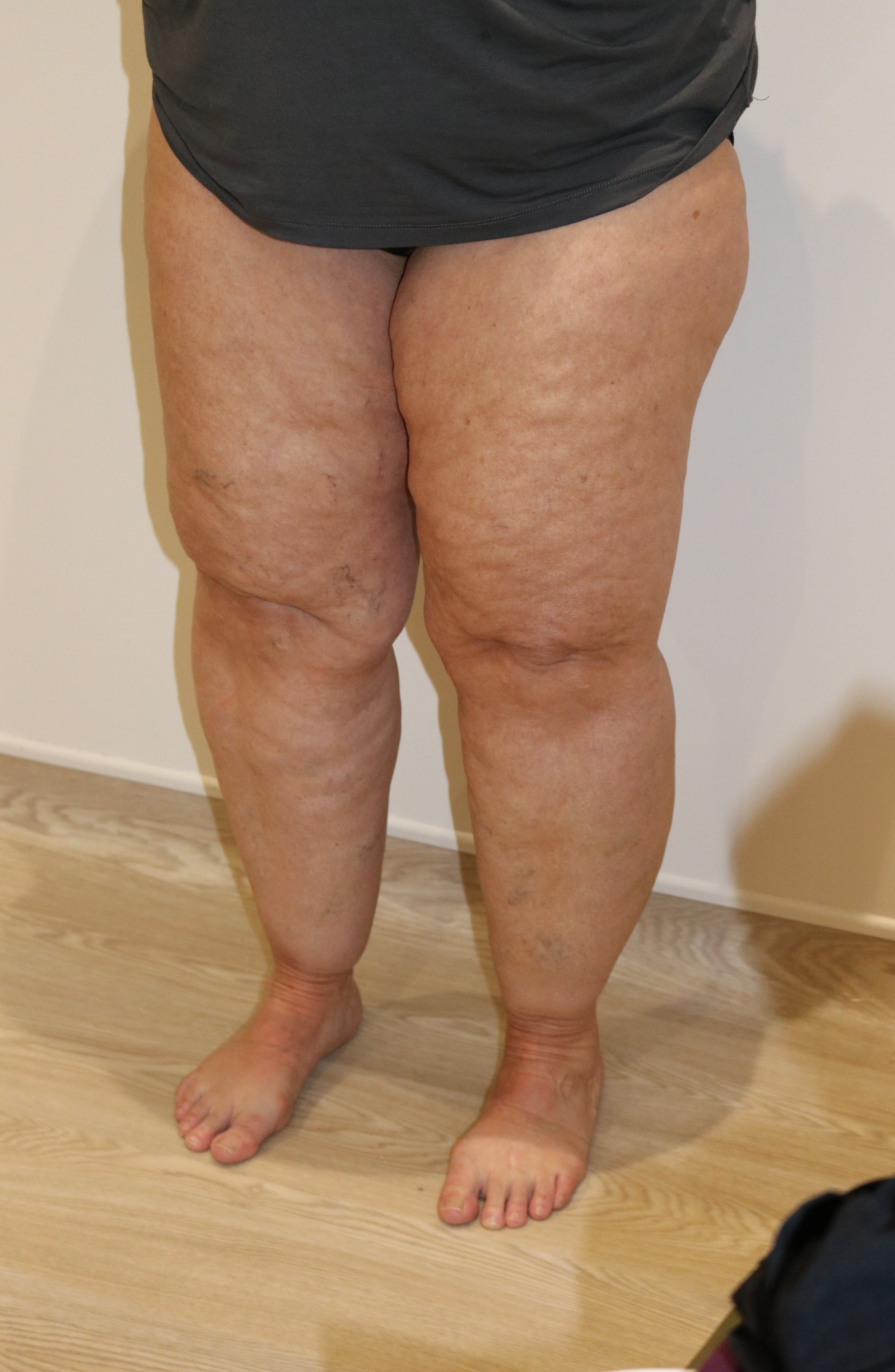 lipoedema lower limbs liposuction type IV before left oblique