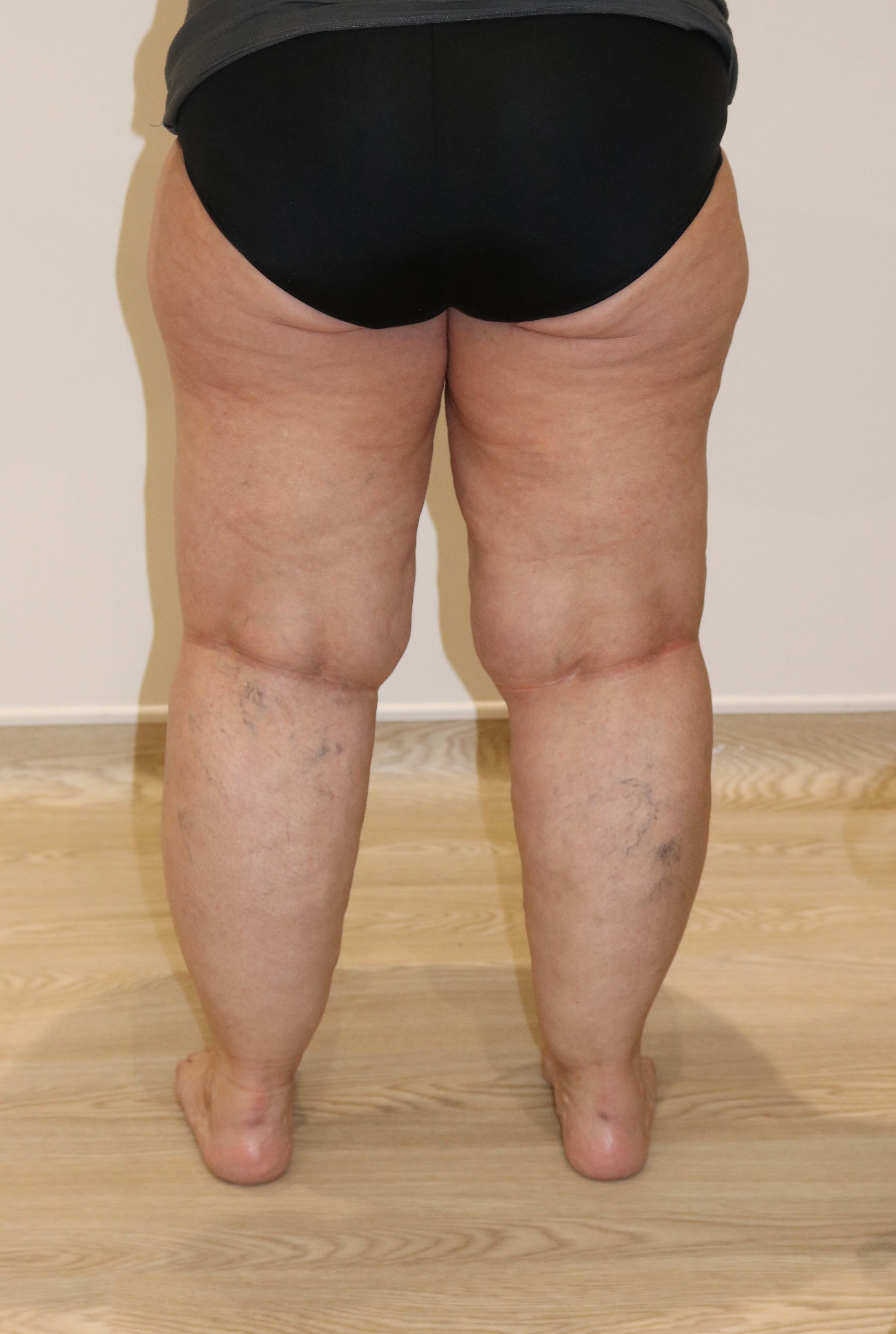 lipoedema lower limbs liposuction type IV before posterior view
