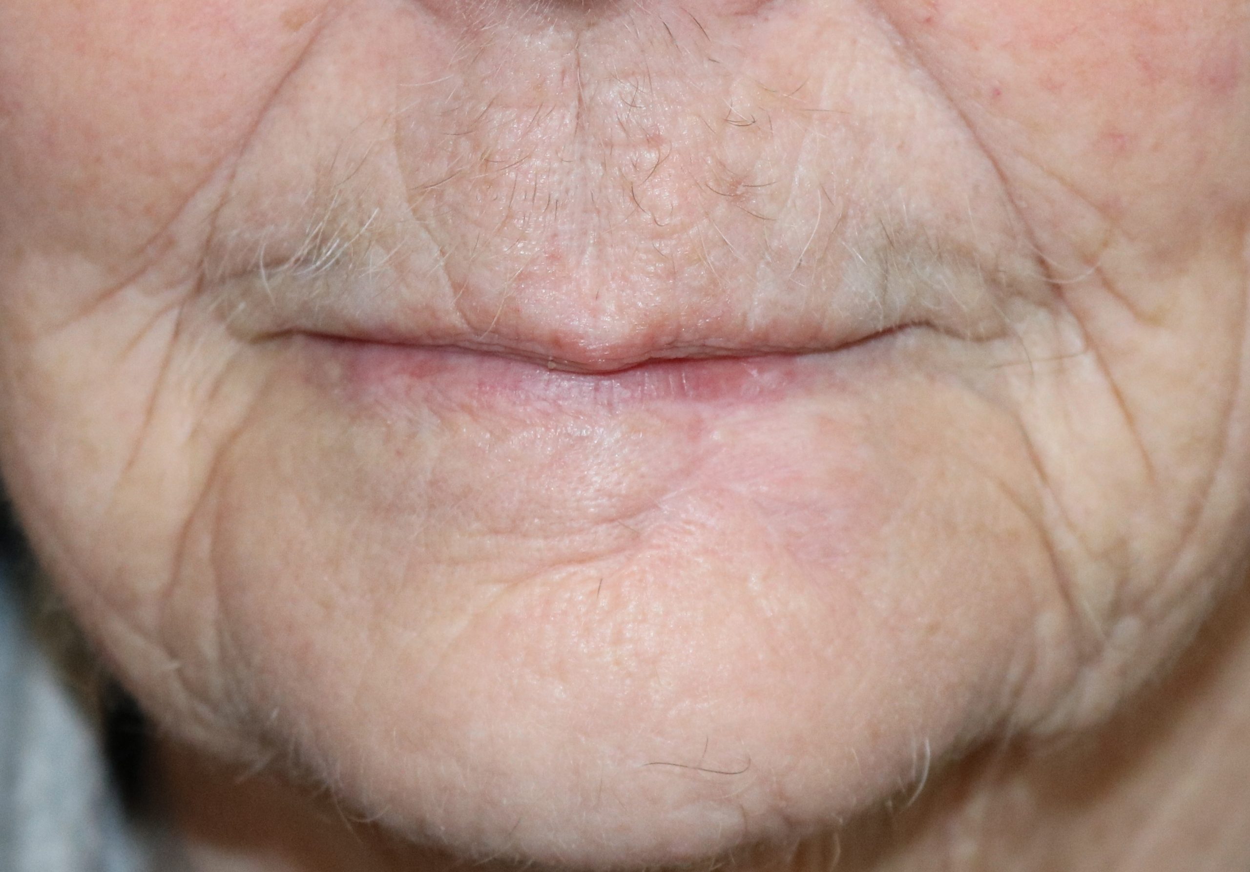 lower lip reconstruction patient 1 after 1 scaled