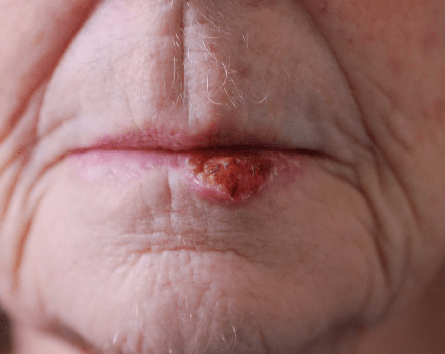 lower lip reconstruction patient 1 before