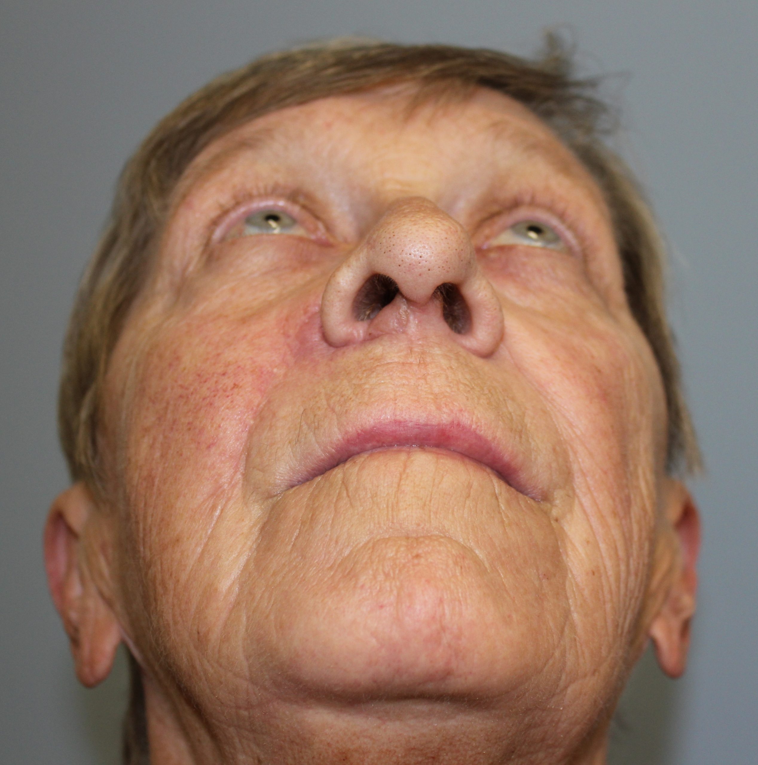 nasolabial flap patient 1 after wormseye view scaled