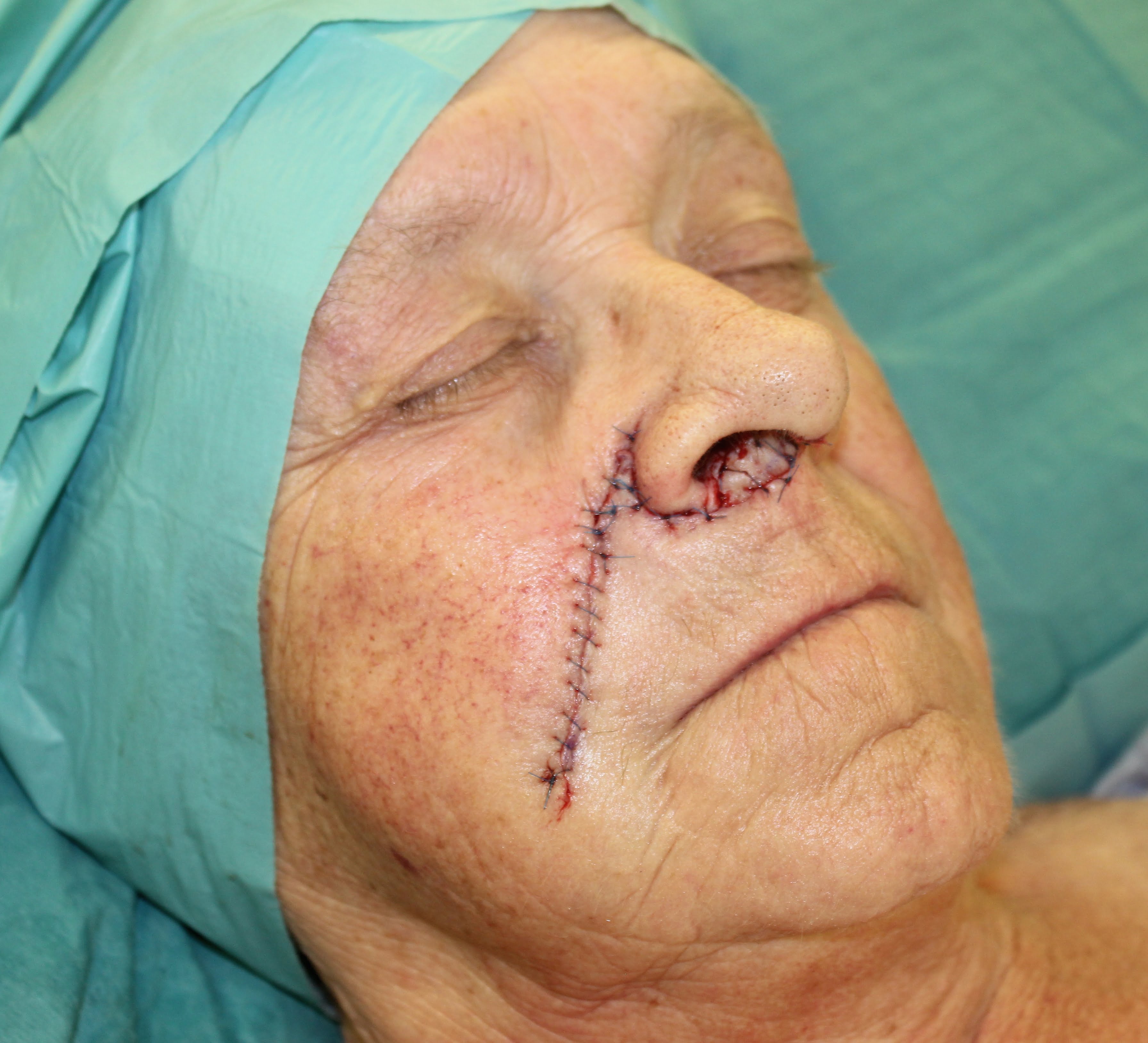 nasolabial flap patient 1 immediate appearance