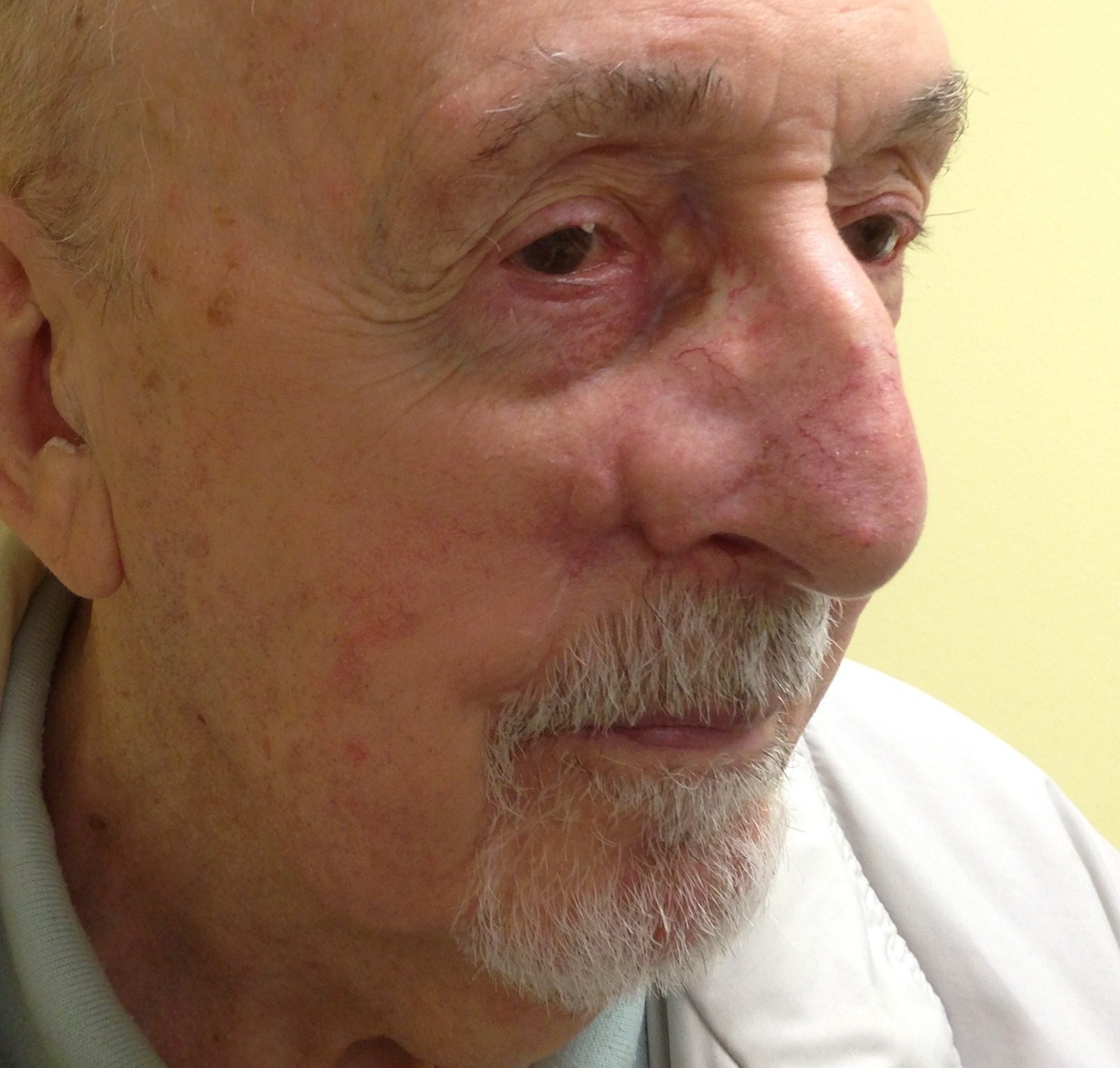 nasolabial island flap patient 2 after