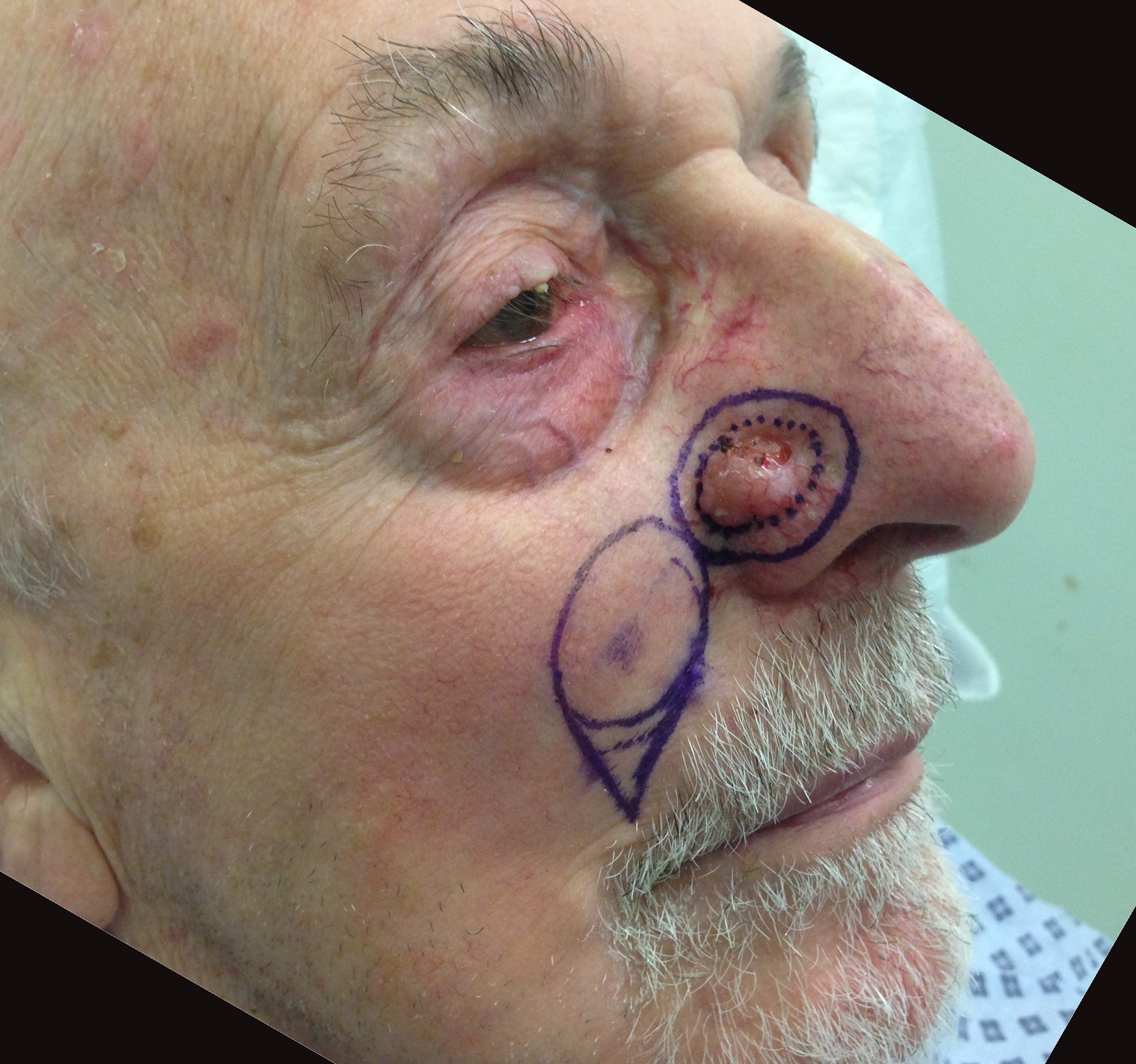 nasolabial island flap patient 2 flap design