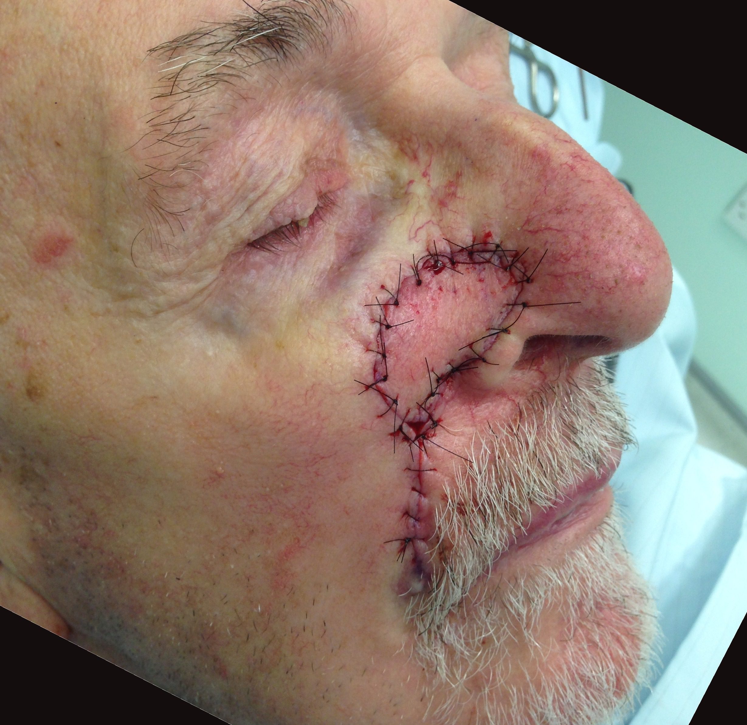 nasolabial island flap patient 2 flap inset