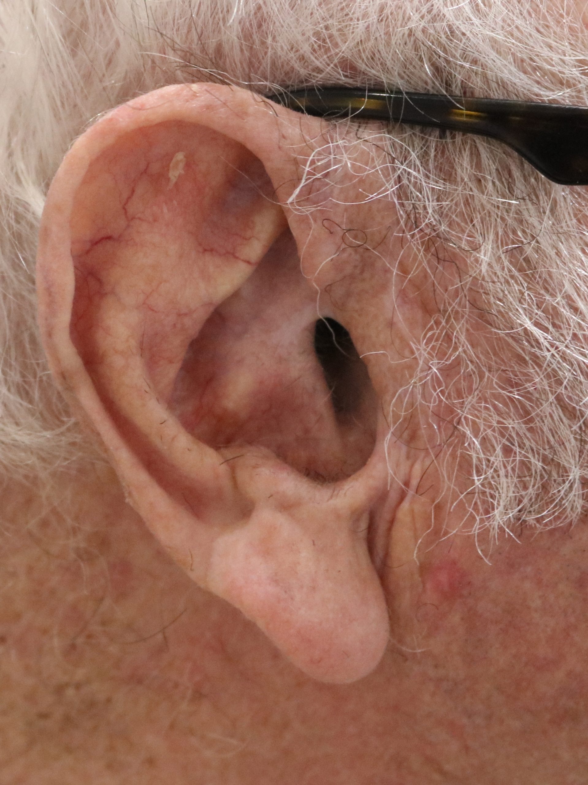 pre auricular flap patient 1 after scaled