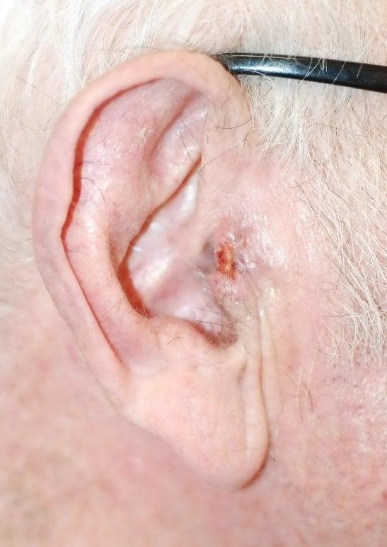 pre auricular flap patient 1 before