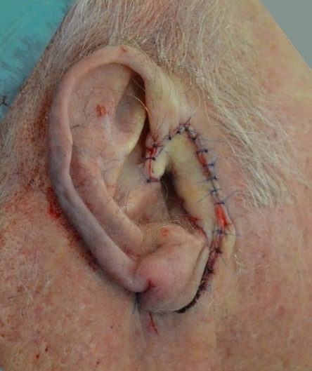 pre auricular flap patient 1 flap inset