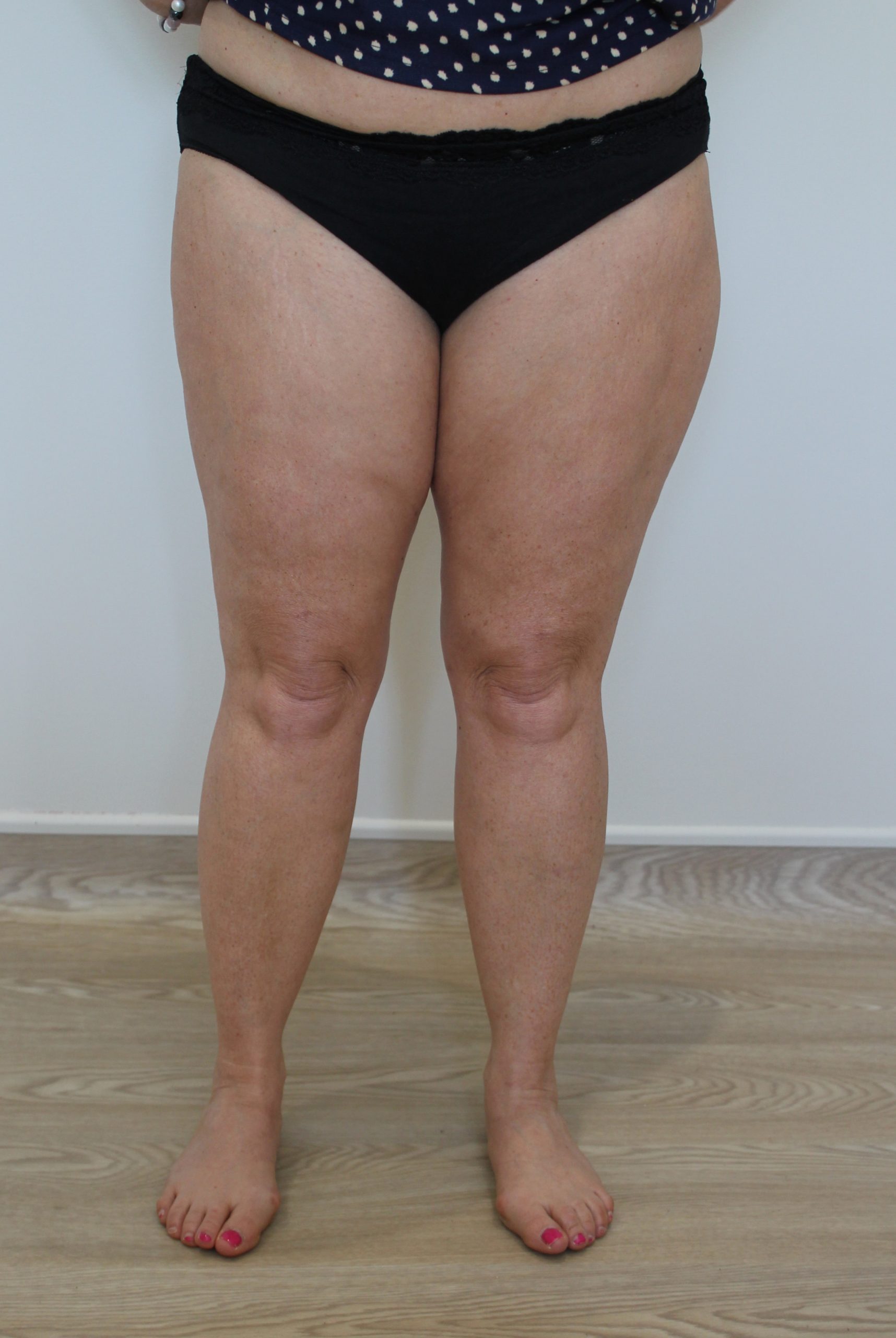 thigh liposuction patient 1 after AP view scaled