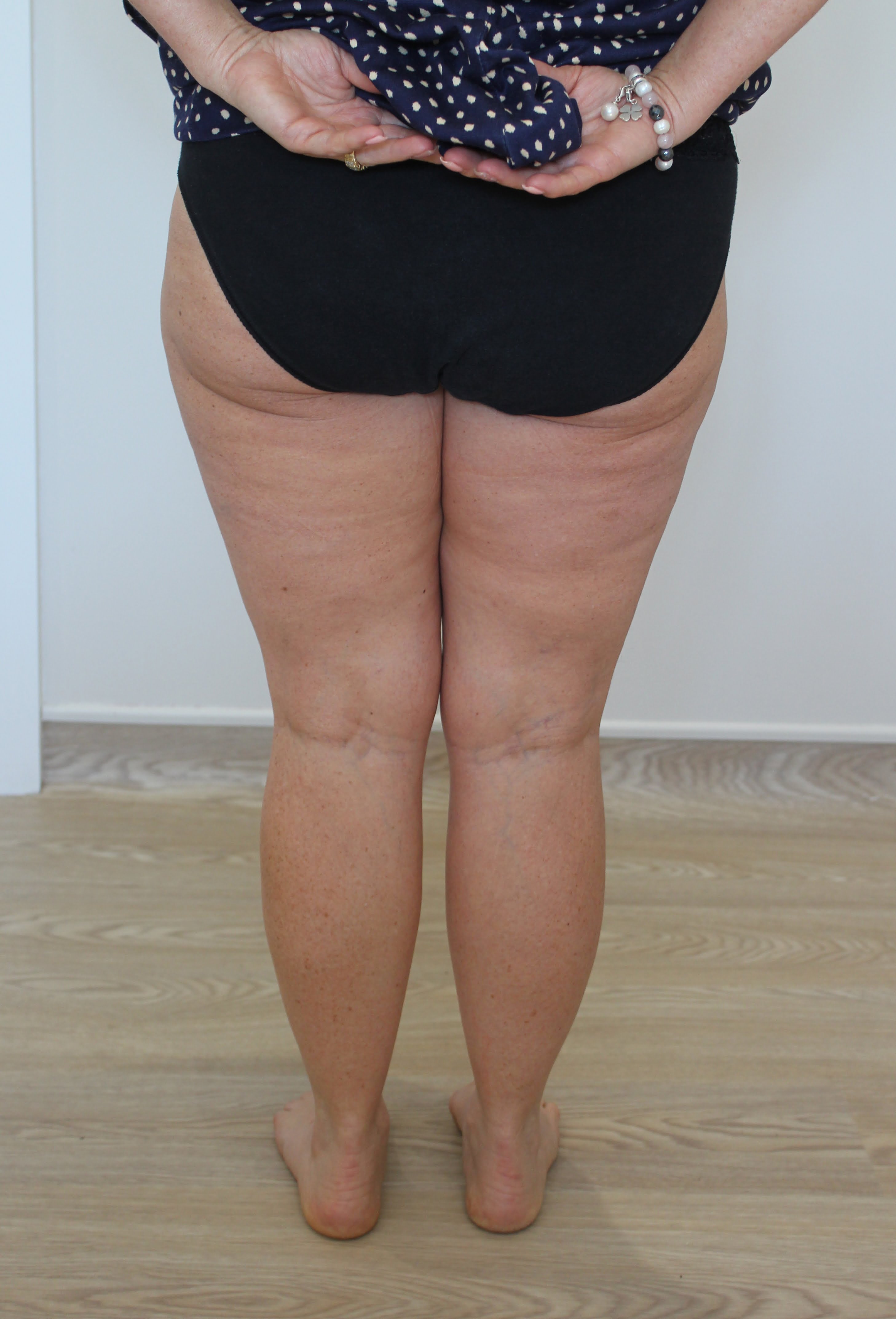 thigh liposuction patient 1 after posterior