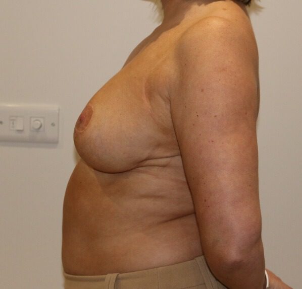 Breast reduction after left lateral