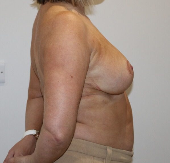 Breast reduction after right lateral